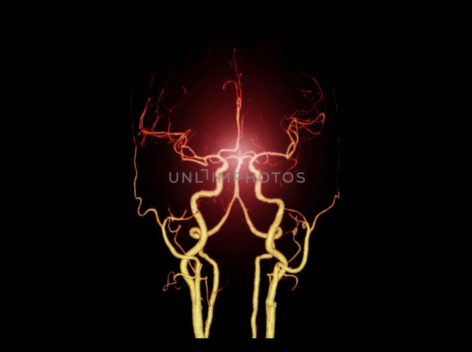 CTA BRAIN or CT angiography of the brain 3D Rendering image showing cerebral artery.
