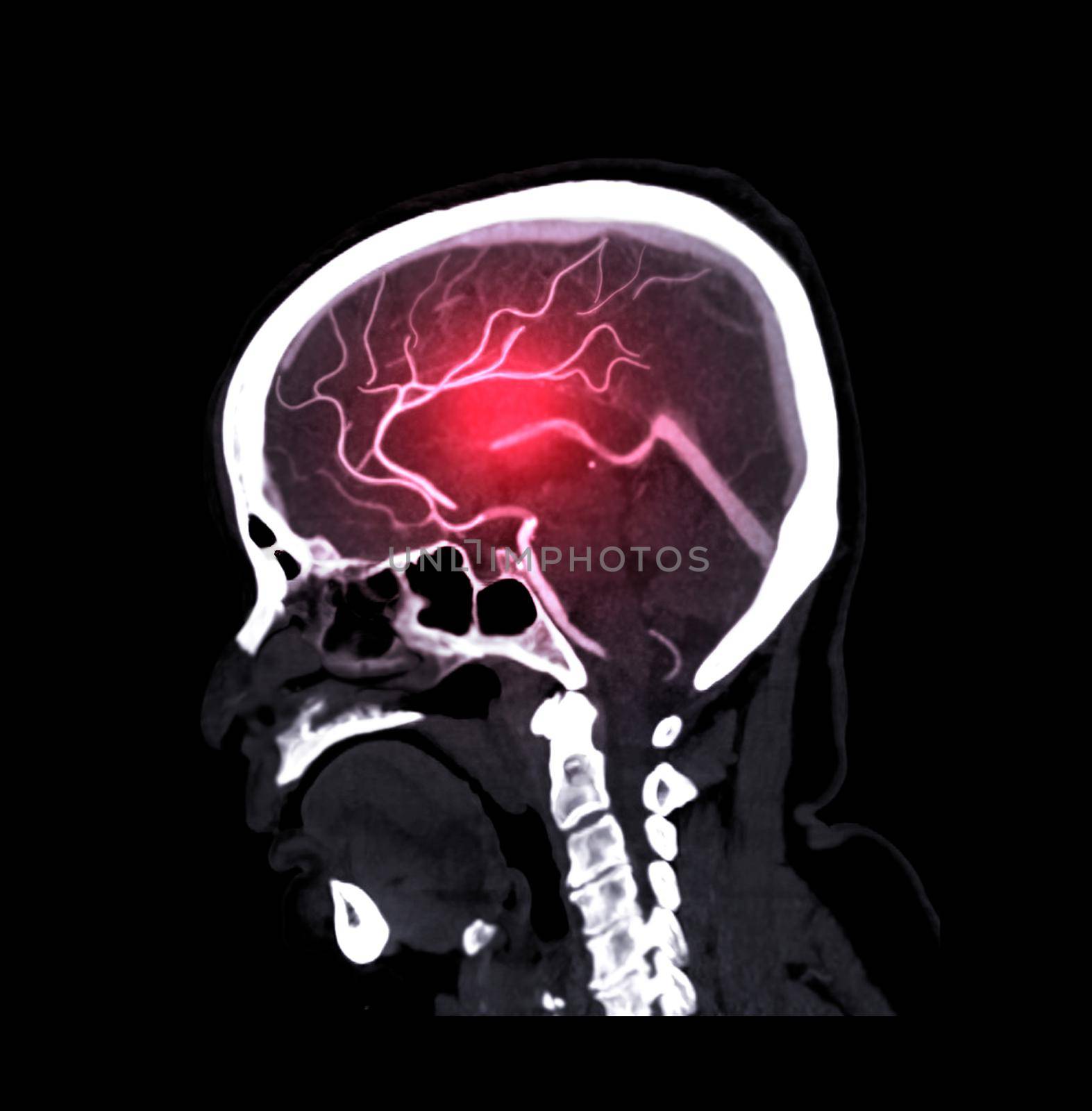 CTA brain or CT angiography of the brain Sagittal view . medical technology concept.