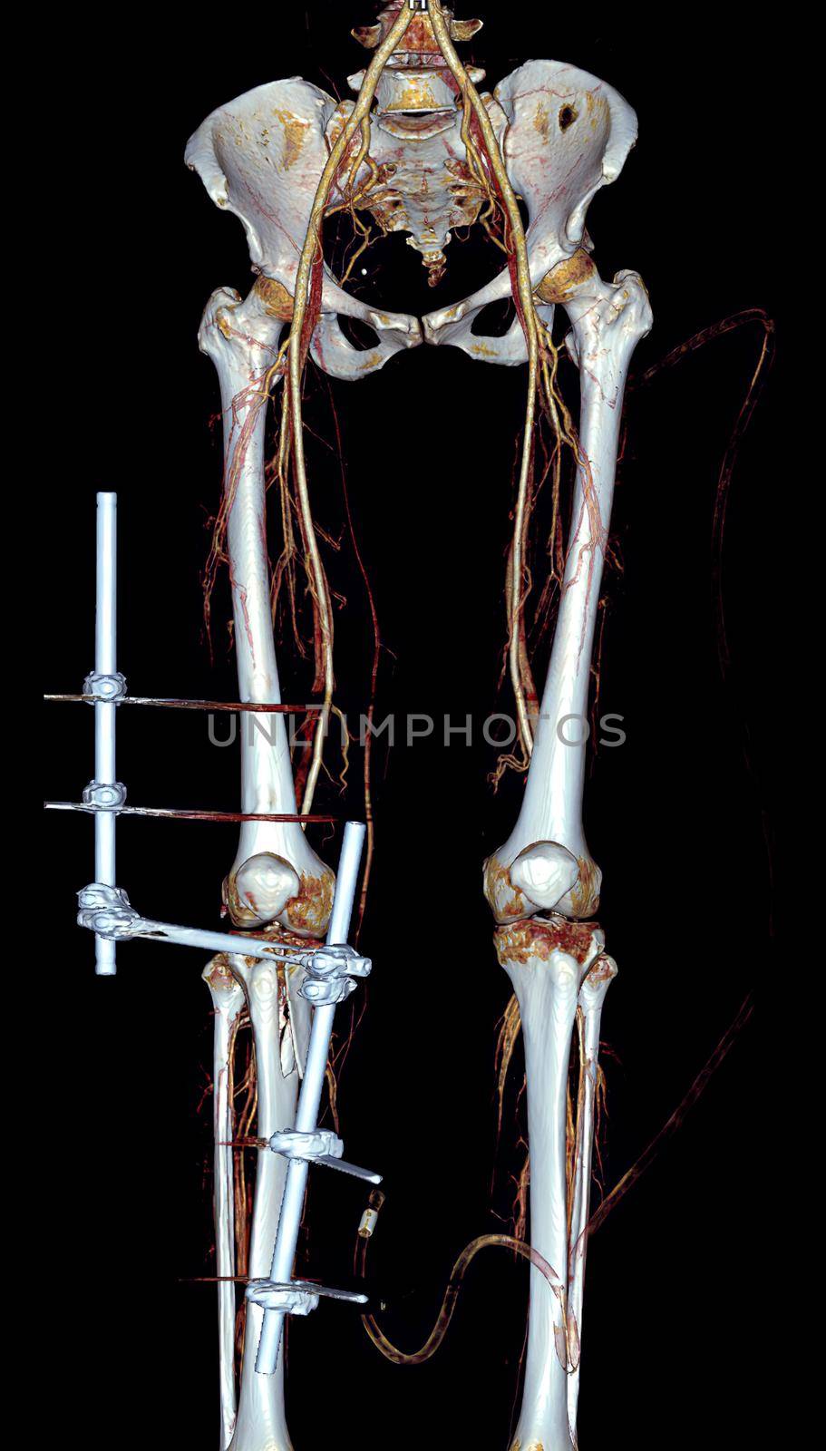 CTA femoral artery run off 3D rendering image of femoral artery for detect vasucular injury in traumatic patient.