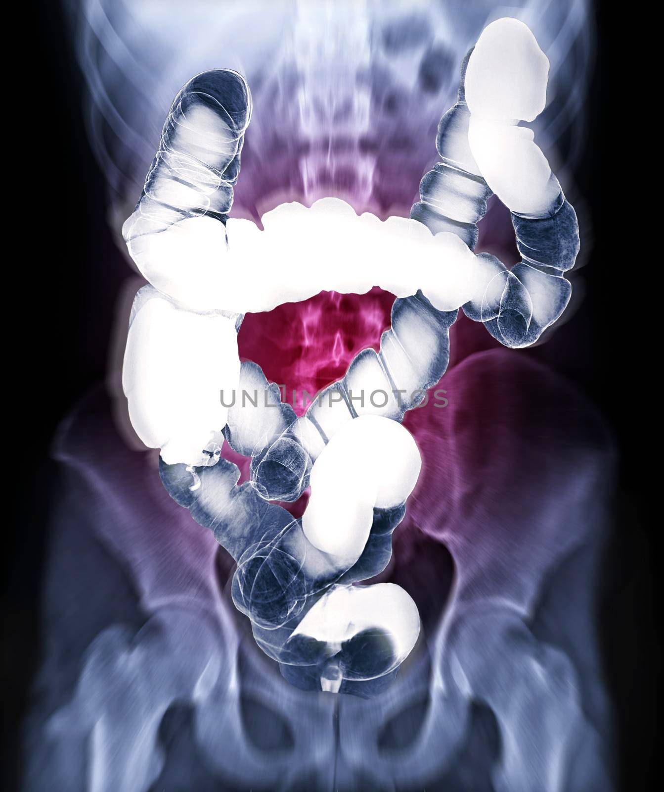 Selective focus of barium enema image or x-ray image of large intestine isolated on blurred abdomen x-ray backgroung showing anatomical of colon for detect Colon cancer . Clipping path.