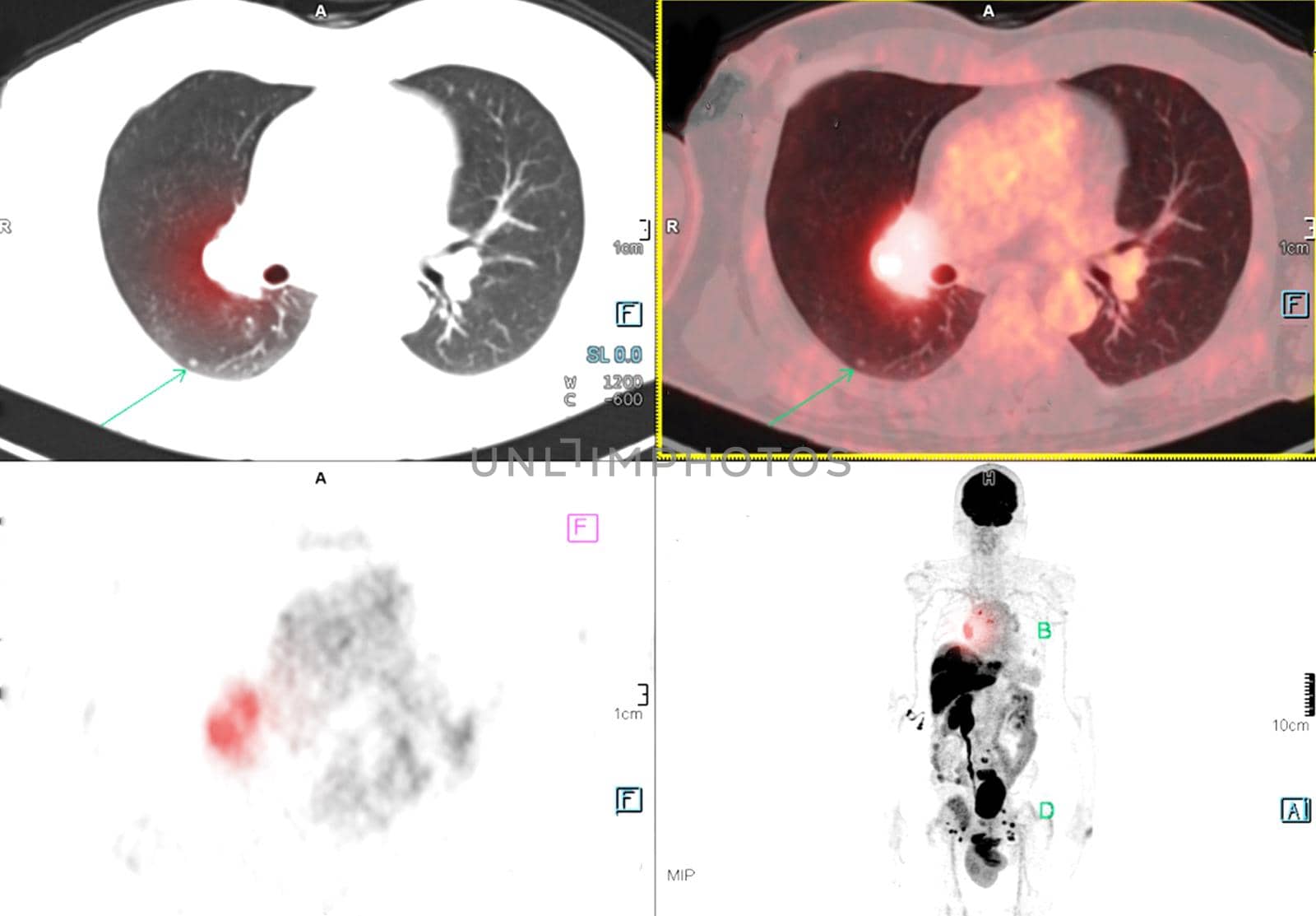 PET Scan image of thorax or chest Comparison Axial , Coronal for detect lung cancer recurrence after surgery. medical technology concept.