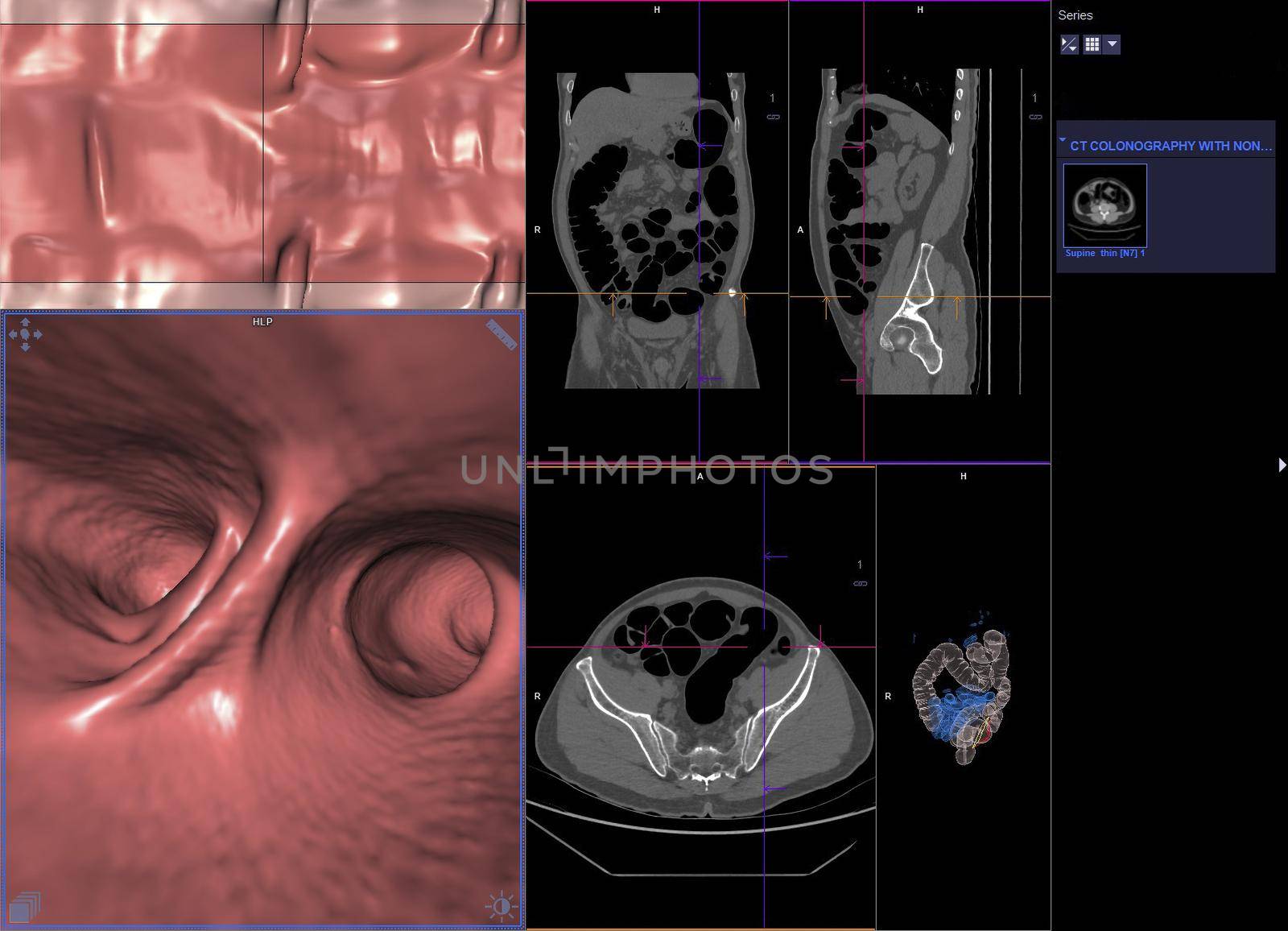 CT colonography or CT Scan of Colon axial view vs Coronal view and 3D rendering image on the screen for diagnosis large bowel cancer.