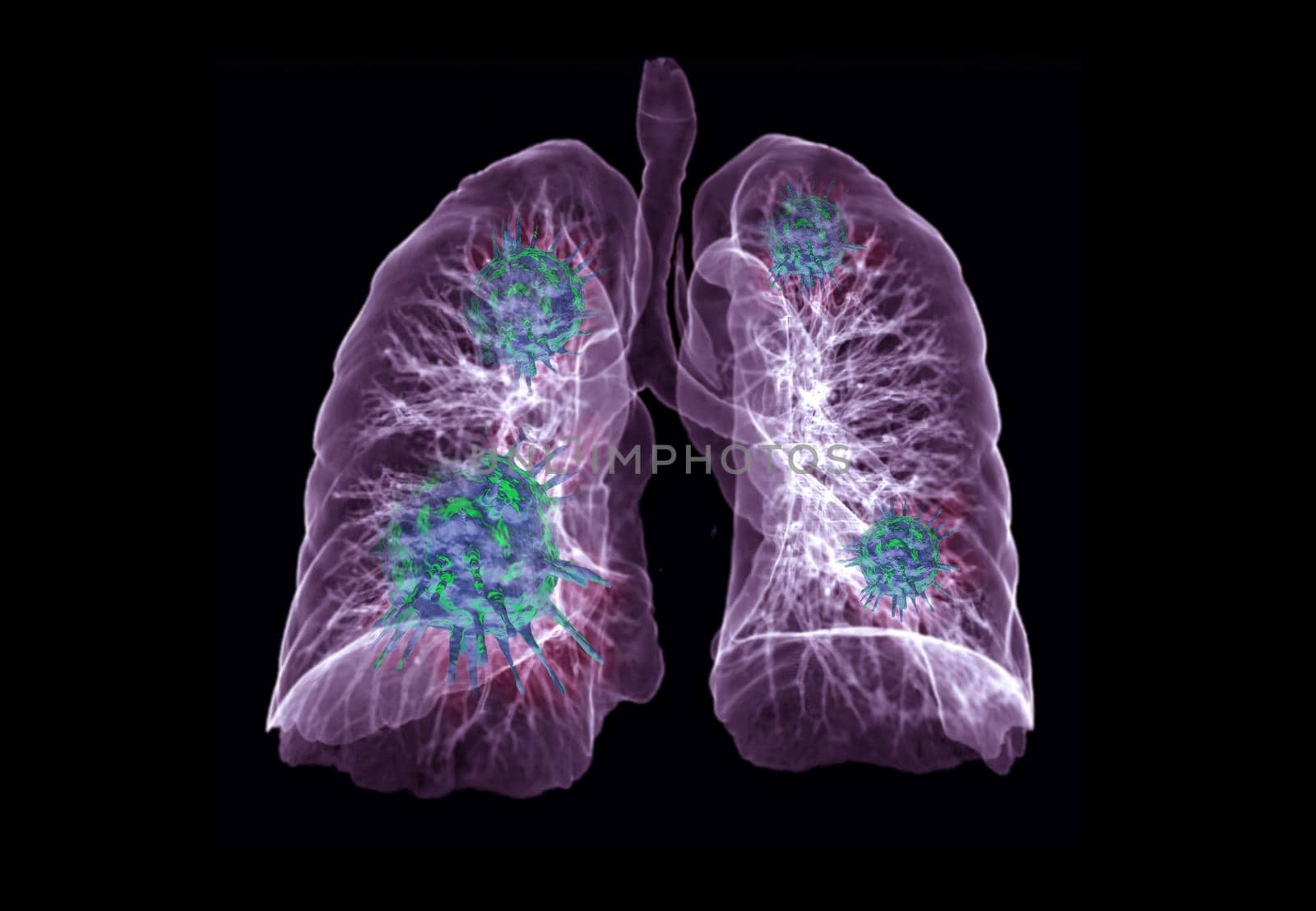 CT Chest or Lung 3D rendering image with virus 3D rendering on black background for diagnosis TB,tuberculosis and covid-19 .