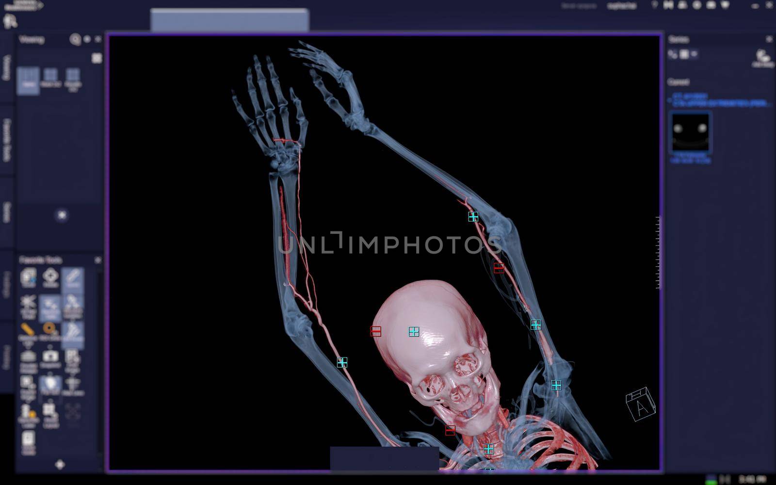 CTA brachial artery or CT scan of upper extremity or the Arm 3d rendering image on blurred screen.