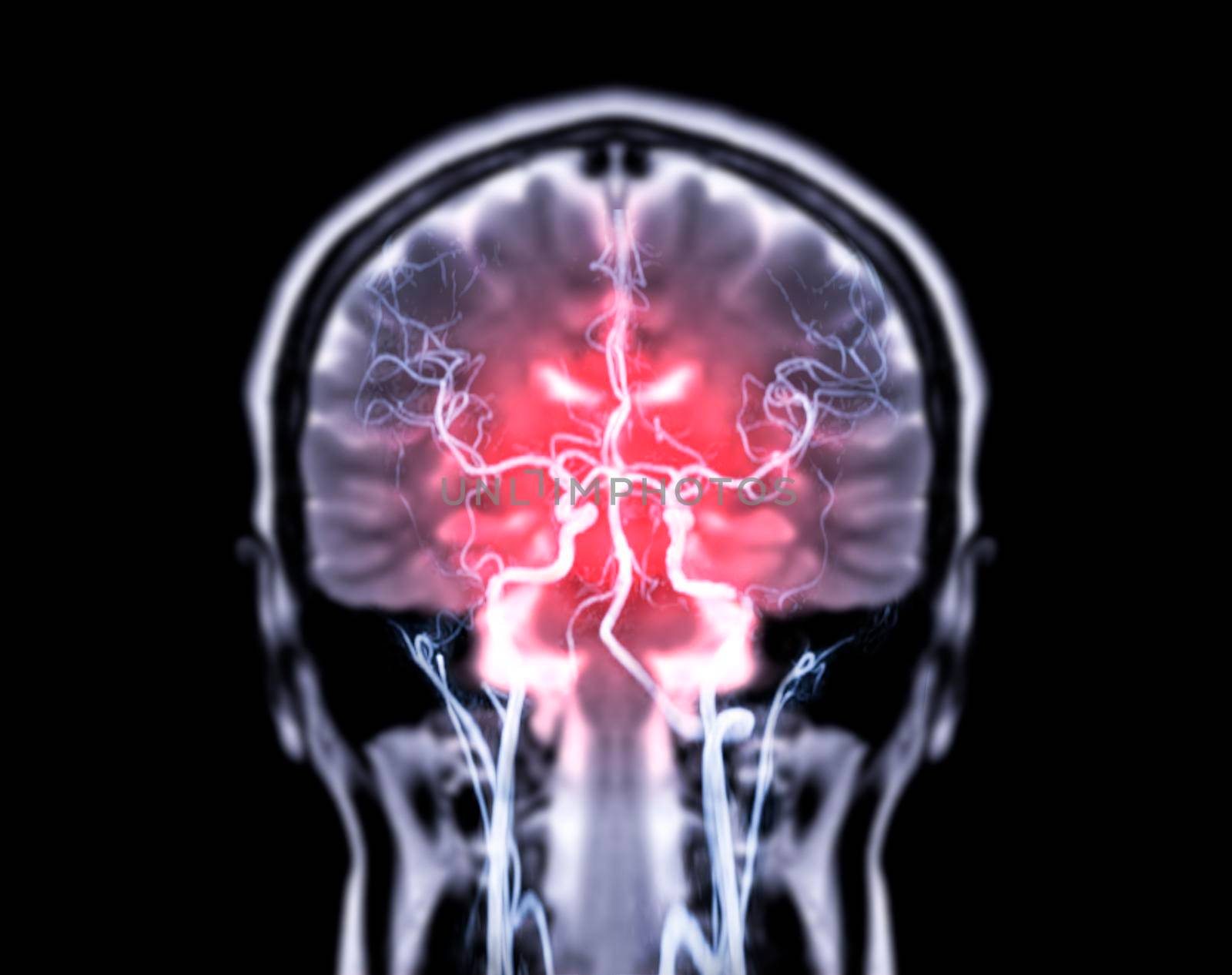 MRI brain Coronal T2W and MRA Brain fusion in Coronal view.