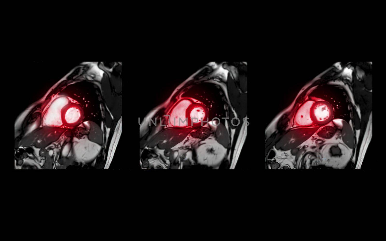 MRI heart or Cardiac MRI magnetic resonance imaging of heart in short axis view showing cross-sections of the left and right ventricle for detecting heart disease.