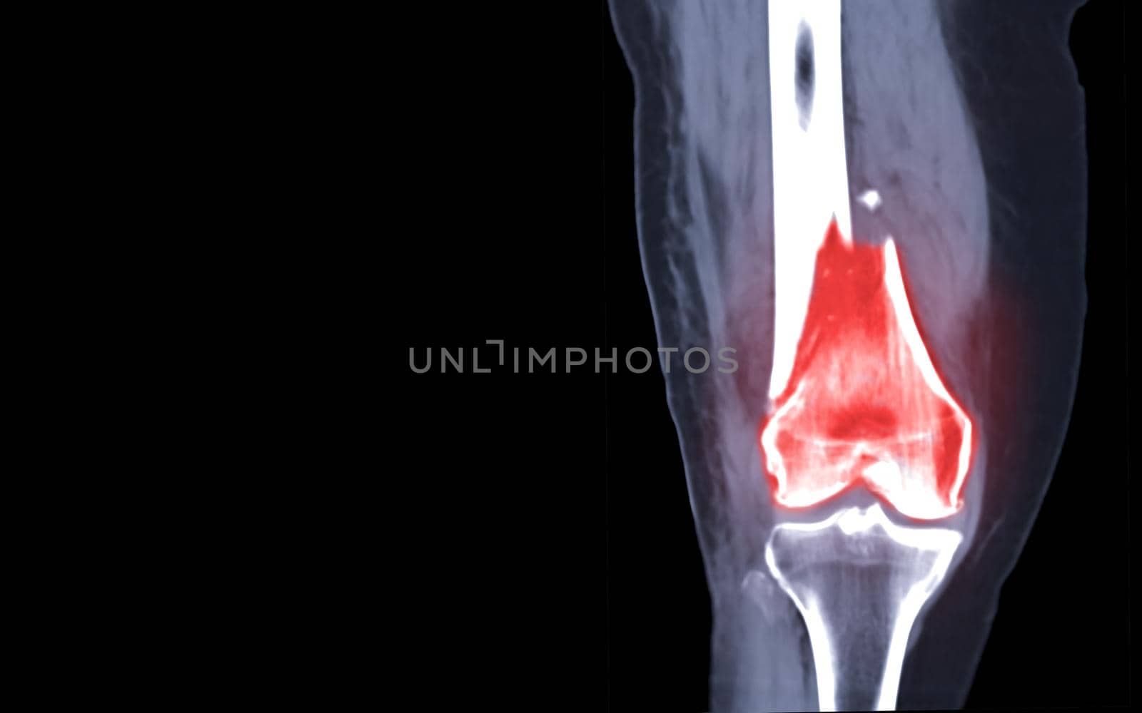 CT knee joint Coronal view isolated on black background showing fracture Femur bone. by samunella