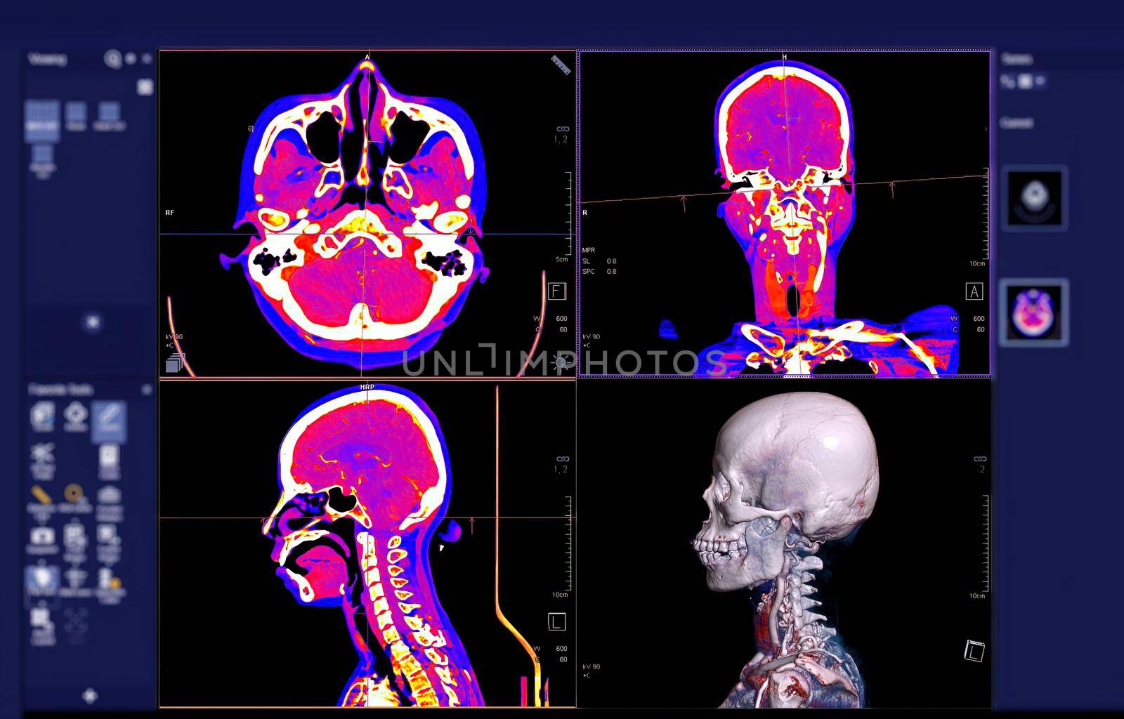 Colorful of CT angiography of the brain or CTA brain comparison Axial , Coronal and Sagittal view and 3D rendering on the screen.