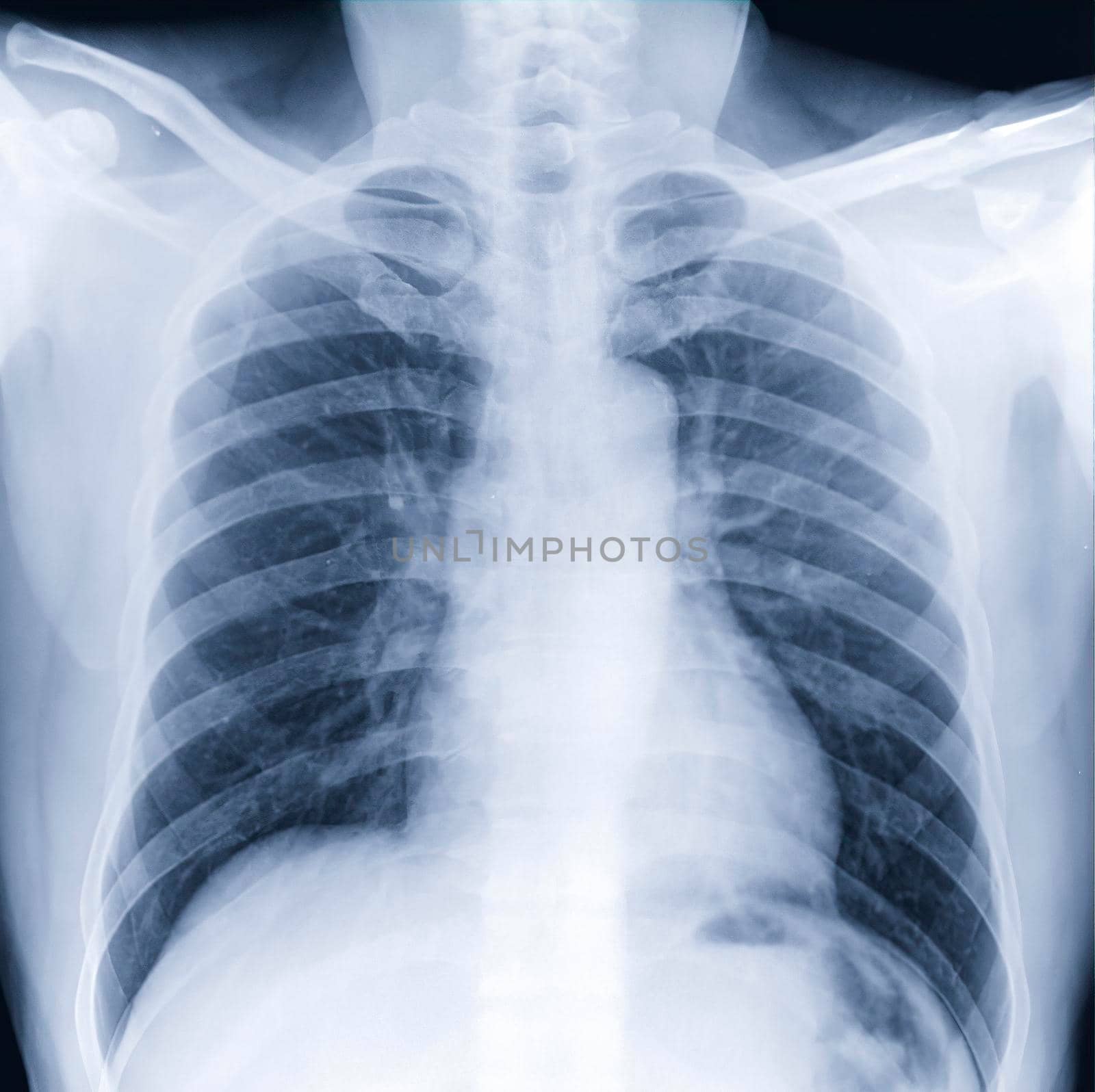 Chest X-ray or X-Ray Image Of Human Chest for a medical diagnosis . check up concept. by samunella