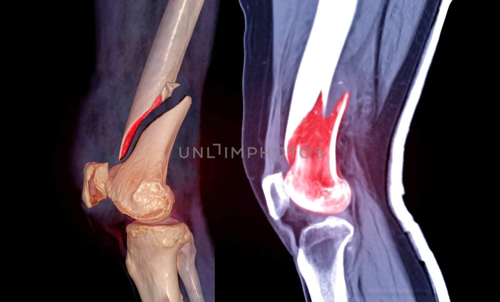 CT knee joint 3D rendering image lateral view and Sagittal view isolated on black background showing fracture Femur bone.