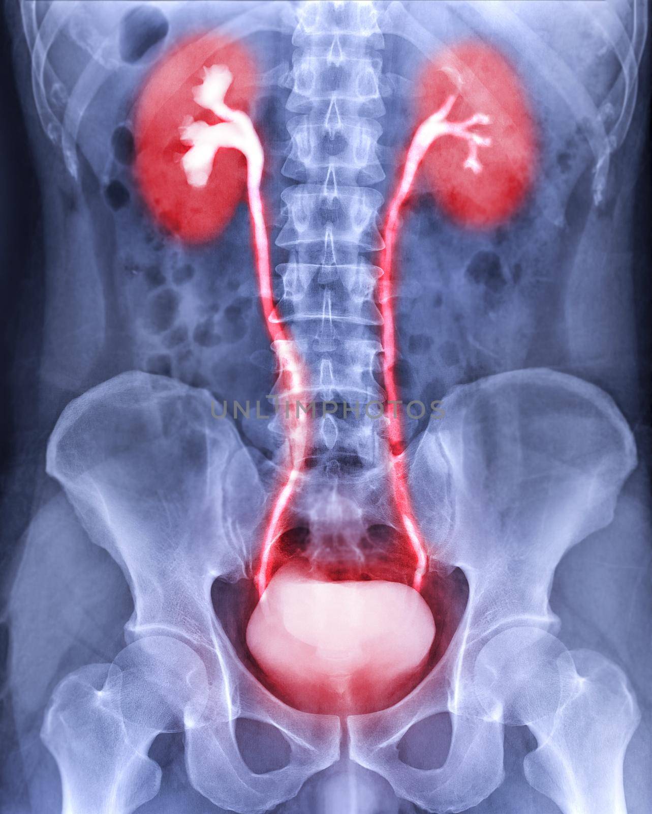 Intravenous pyelogram or I.V.P showing of urinary tract after injection contrast media agent 25 minute.