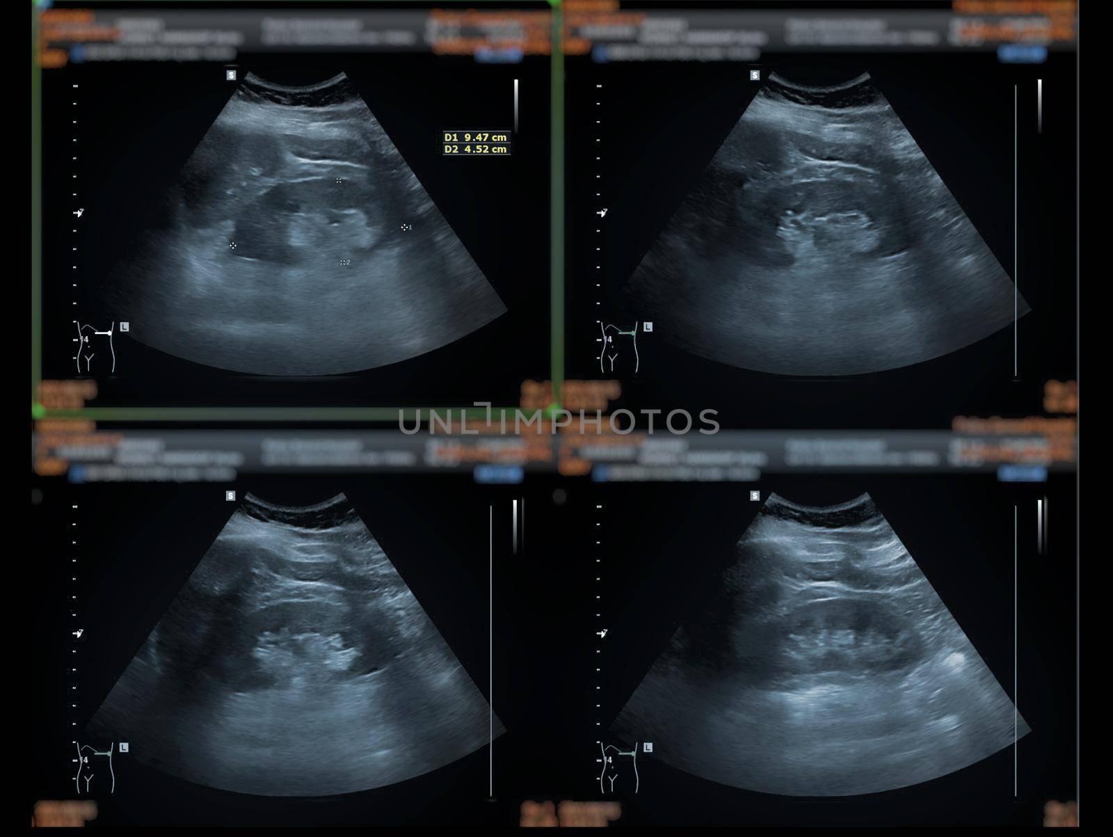 Ultrasound upper abdomen showing Liver, gall bladder and kidney for screening abdominal disease. by samunella