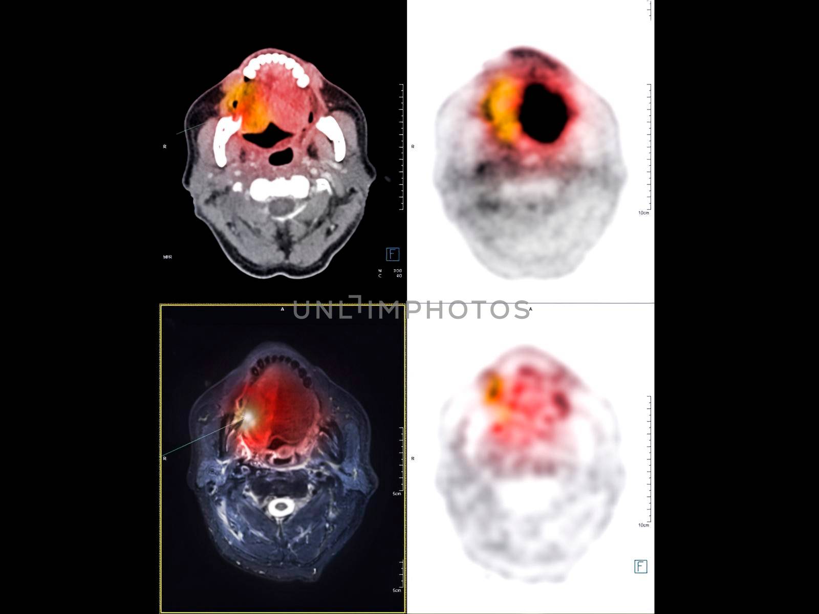 PET CT image of the Neck showing CA nasopharynx or carcinoma of nasopharynx from PET CT scannner.