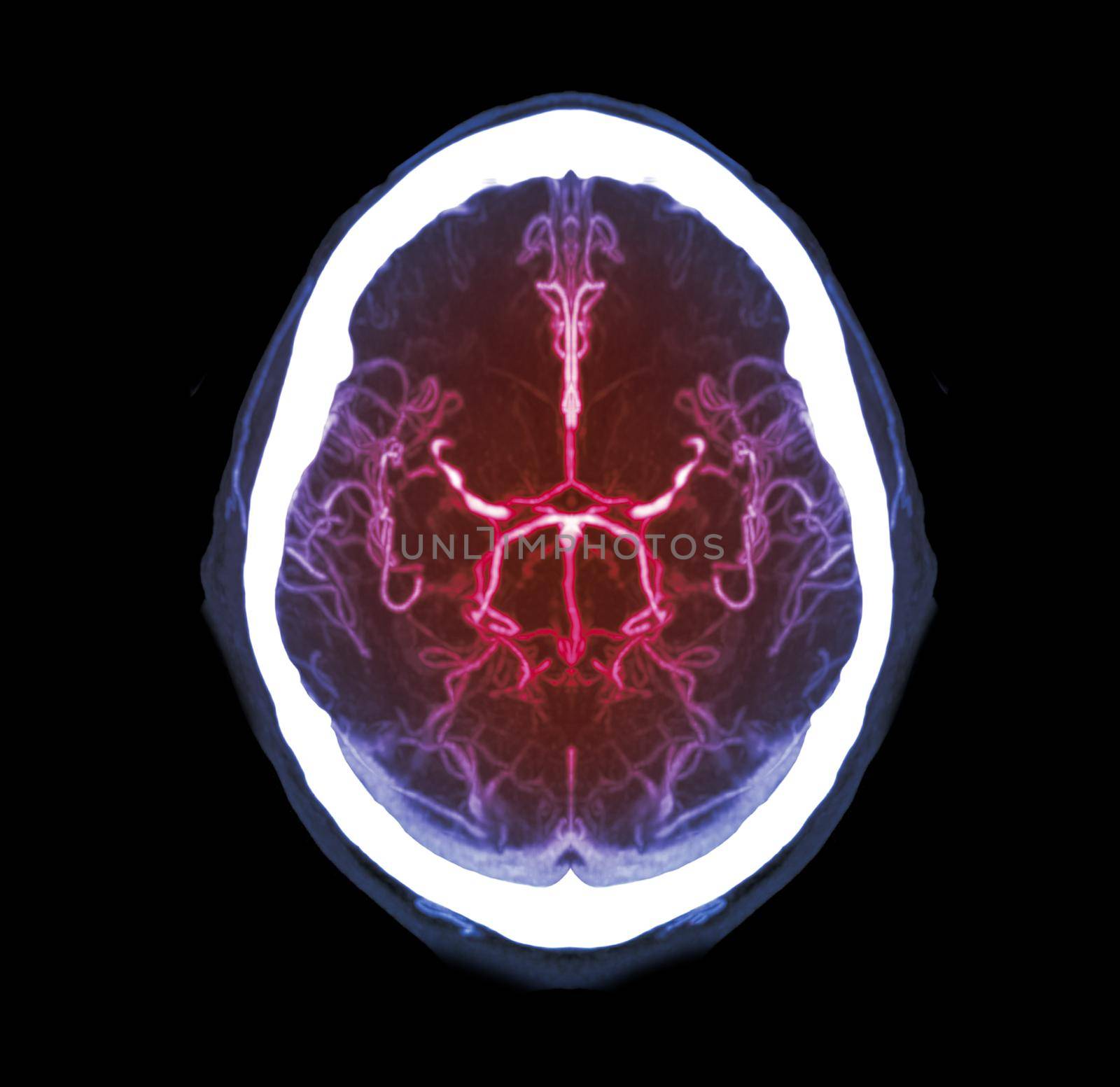 Collection of CTA brain or CT angiography of the brain comparison Mip technique Axial view for detect brain anueurym.