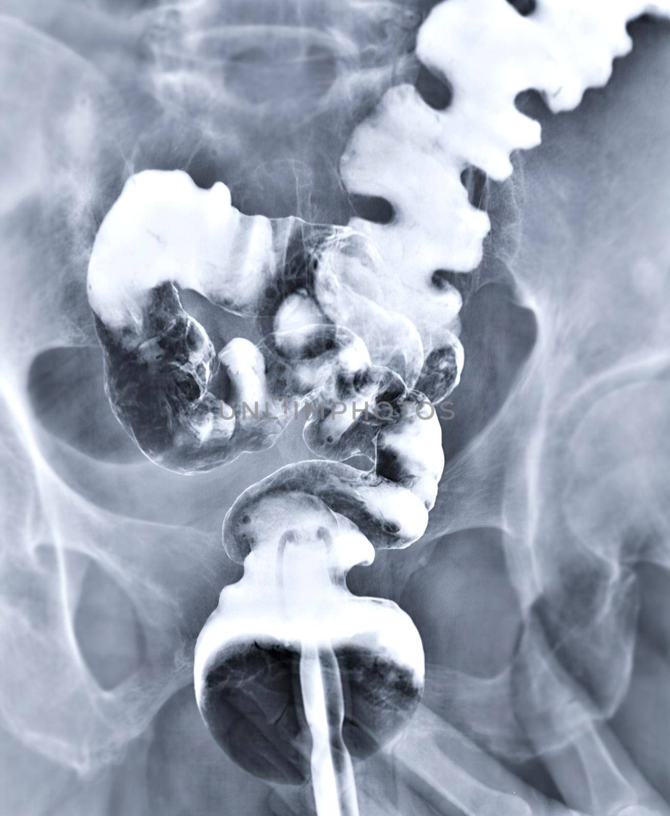 barium enema demonstrated l rectum and colon for diagnosis Colorectal cancer or colon cancer. by samunella