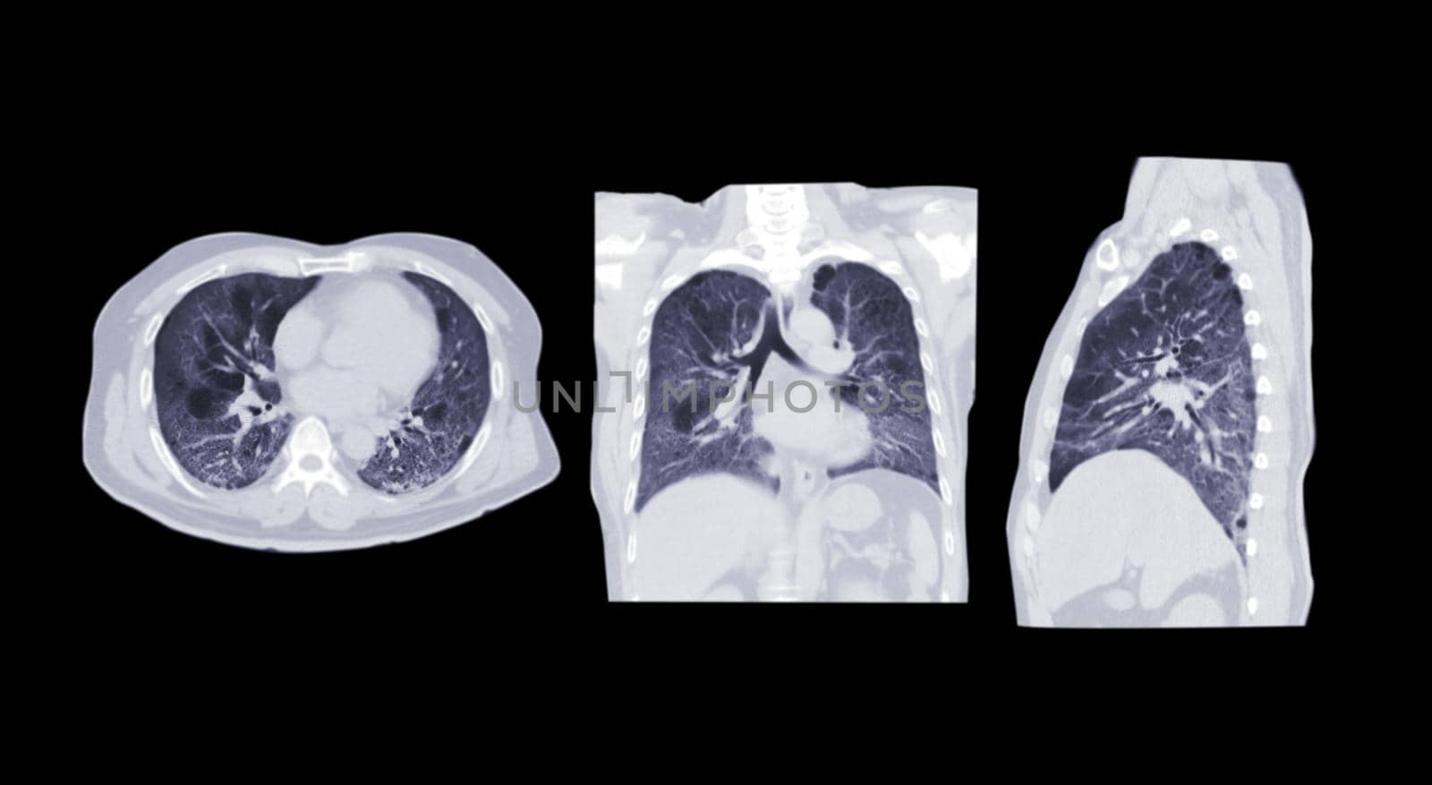 Collection of CT scan of Chest or lung axial, coronal and sagittal view of lung infection covid-19 with ground glass opacity isolated on black background. cliping path. by samunella