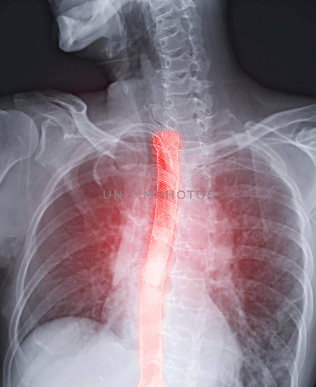 Esophagram or Barium swallow image showing Esophageal stent placement for patient Esophageal cancer. by samunella