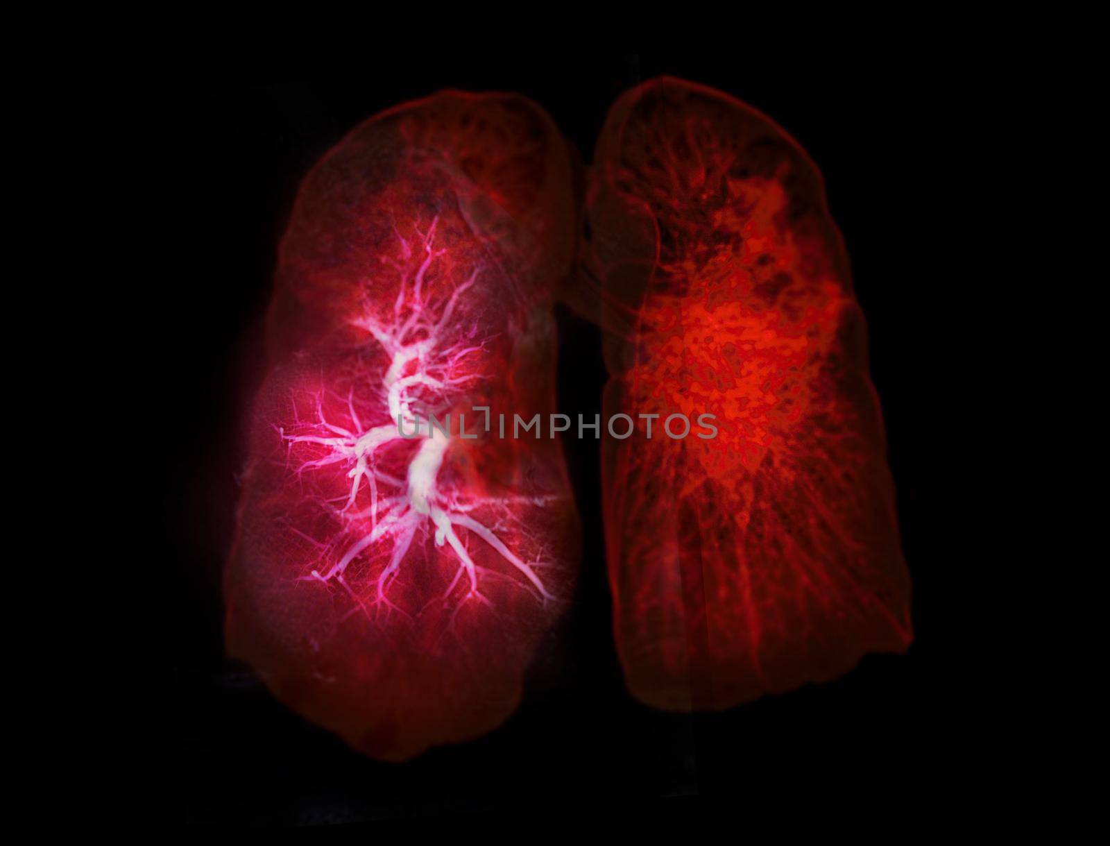 Selective focus of CT Chest or Lung 3D rendering image front view for diagnosis lung diseases ,TB or tuberculosis and covid-19 .
