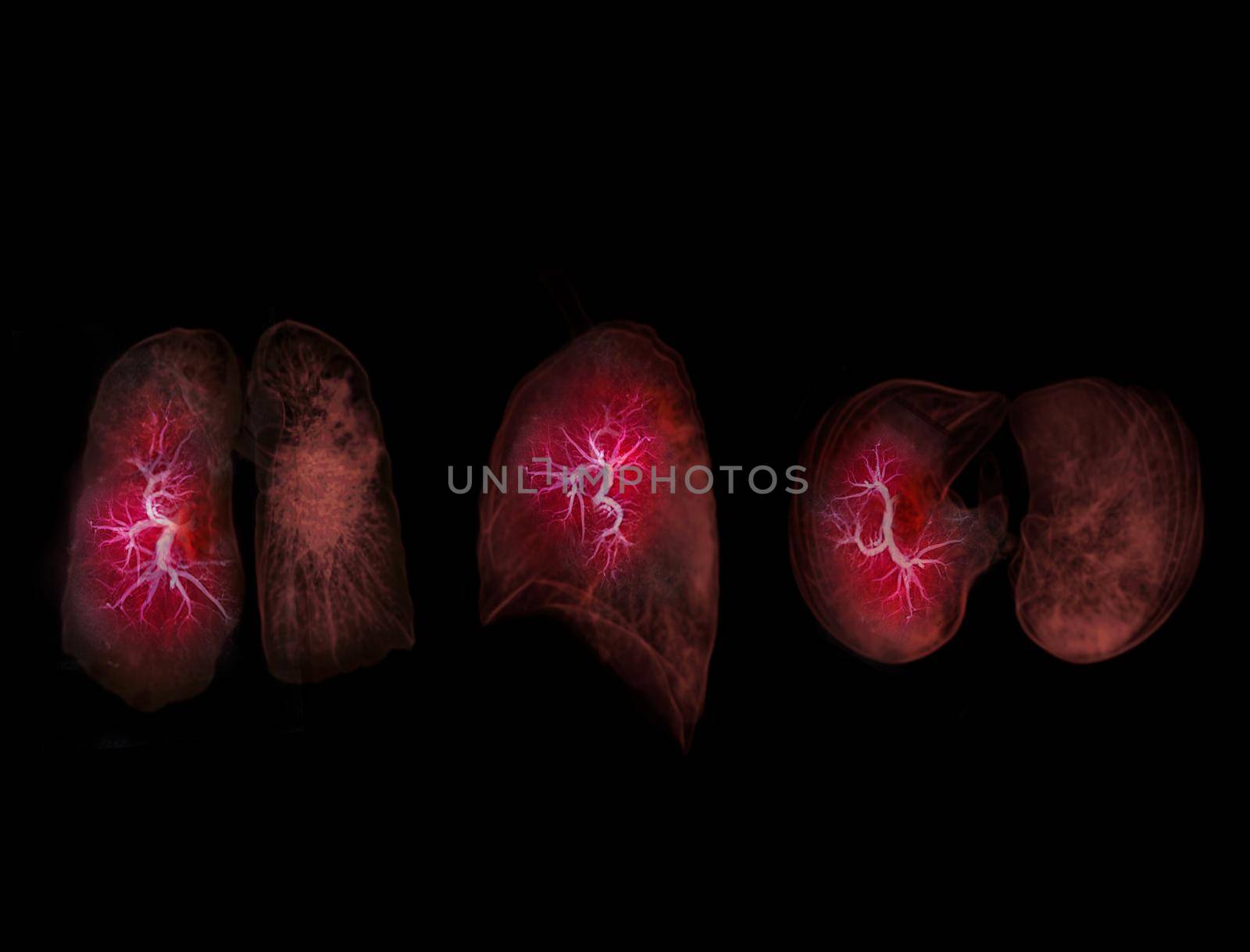 Selective focus of CT Chest or Lung 3D rendering image for diagnosis lung diseases ,TB or tuberculosis and covid-19 . by samunella