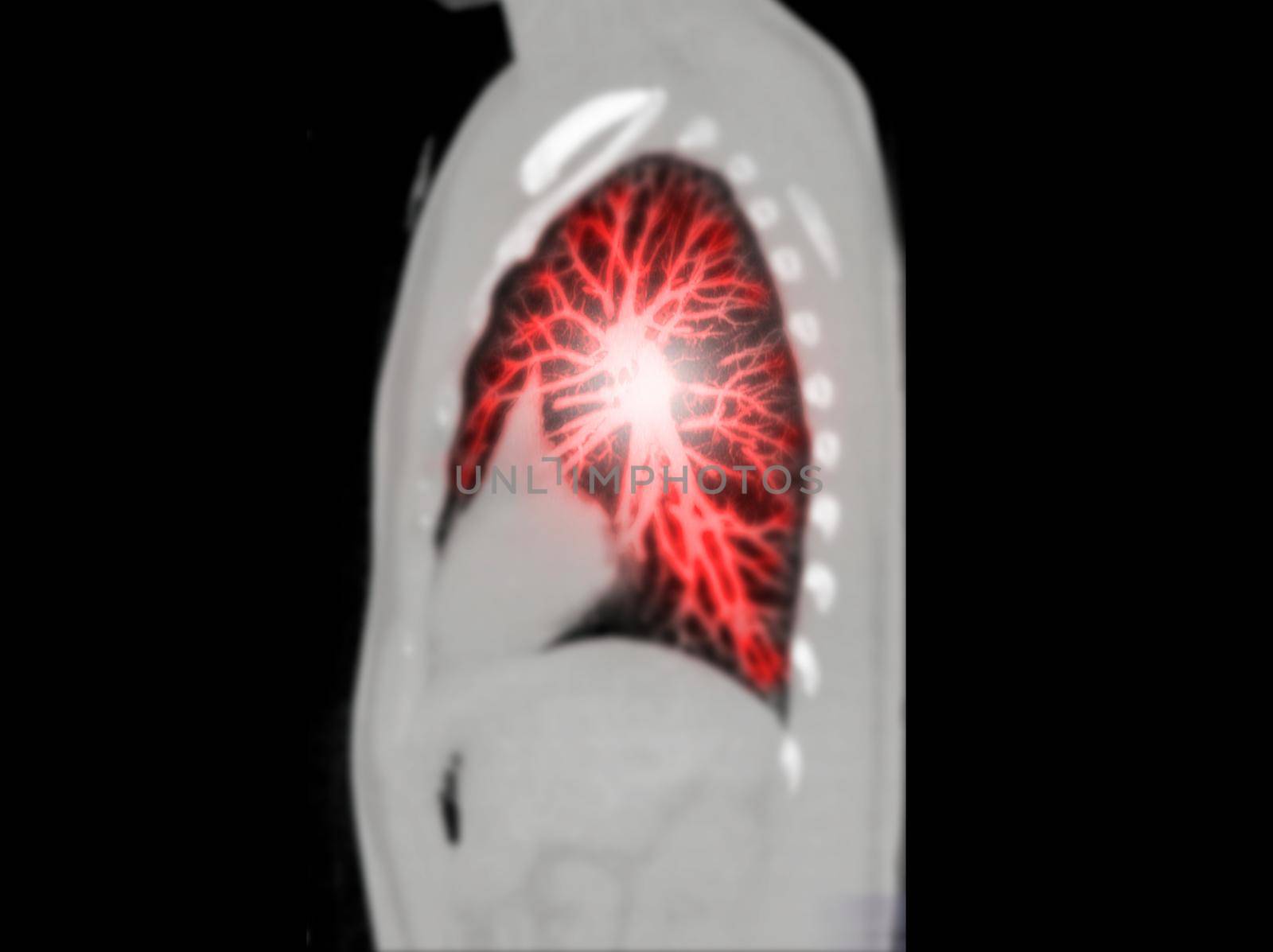 CT Chest Sagittal MIP view for diagnostic lung cancer , tuberculosis and covid-19.