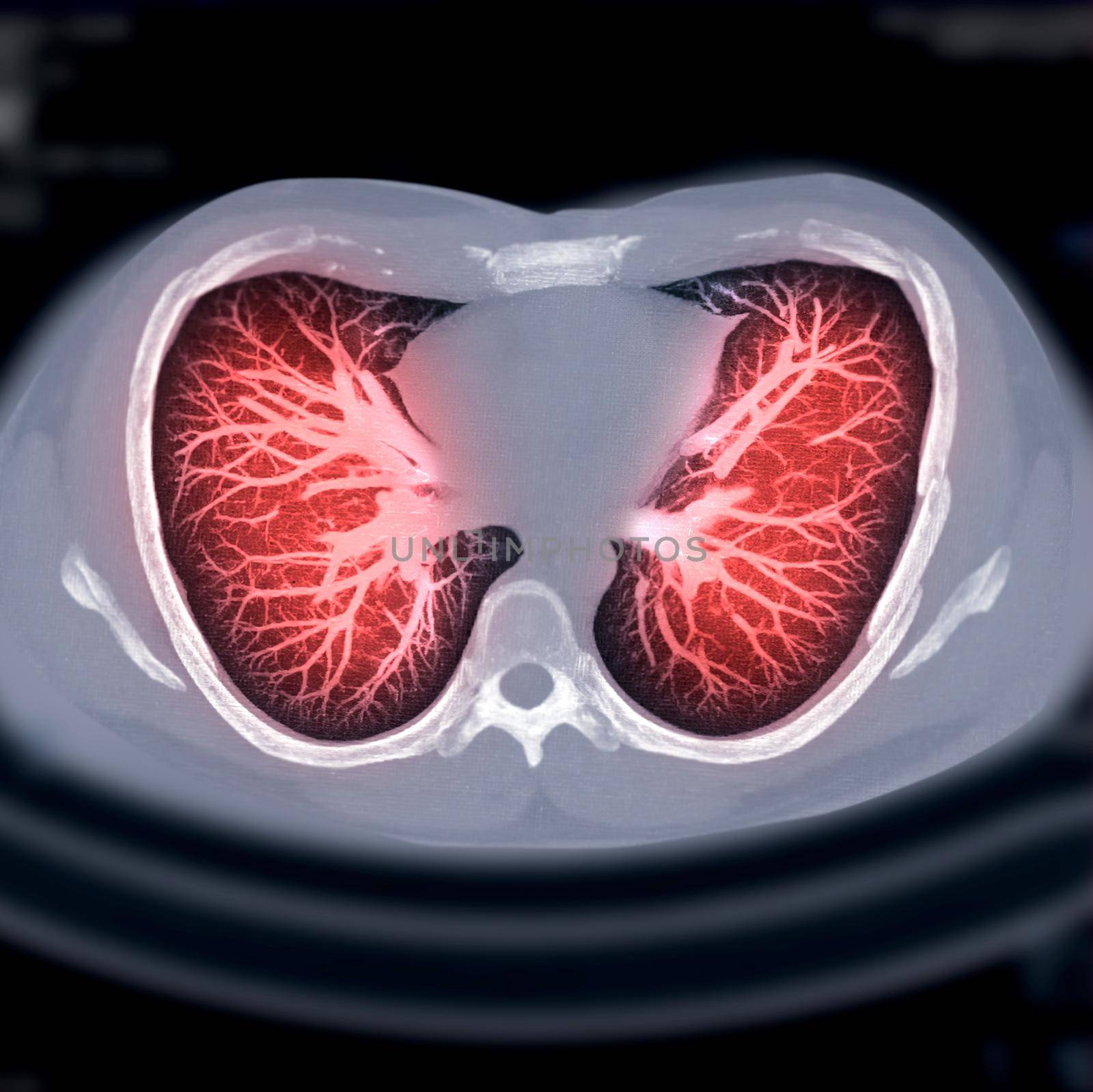 CT Chest AXIAL MIP view for diagnostic lung cancer , tuberculosis and covid-19.