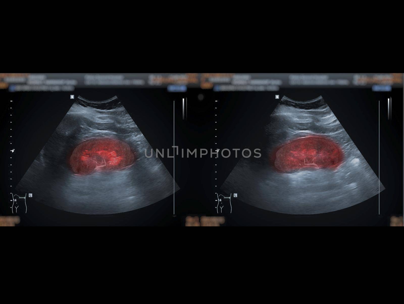 Ultrasound upper abdomen showing kidney for screening renal disease. by samunella