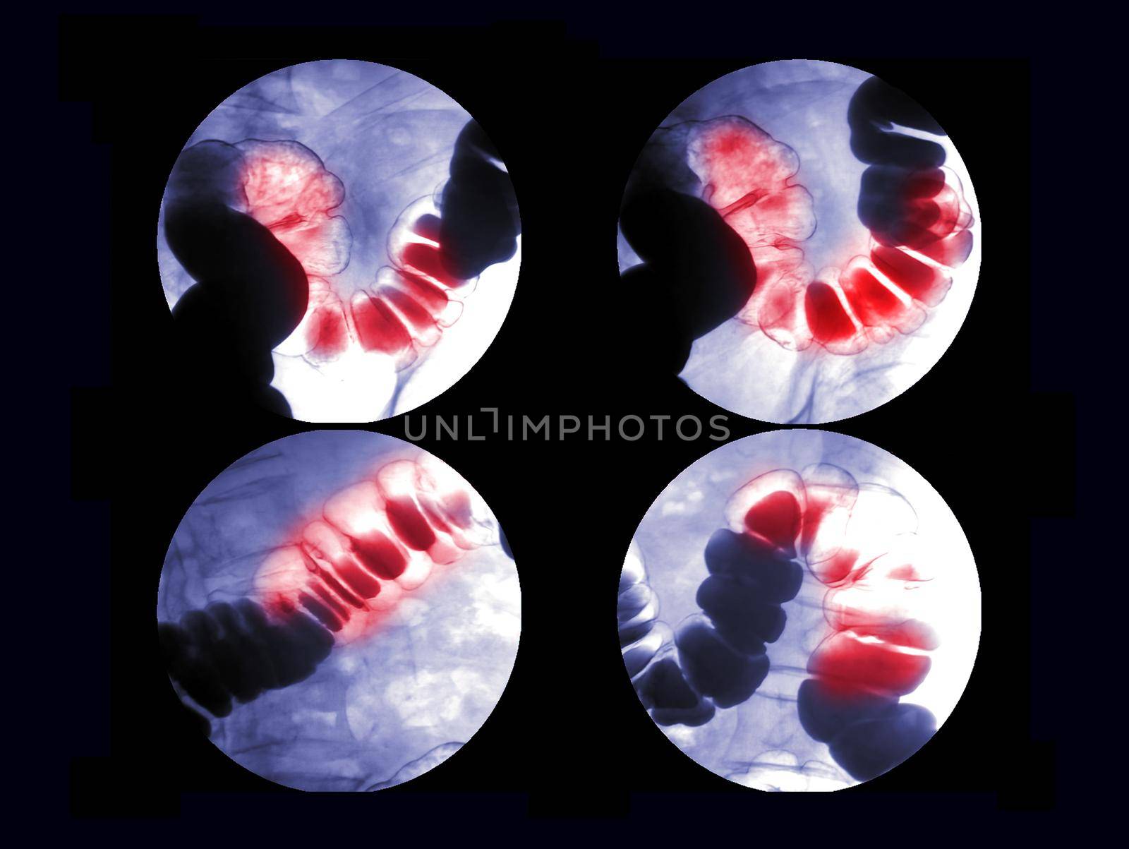 Barium enema or BE is image of large bowel after injection of barium contrast fill into colon under fluoroscopic control by samunella