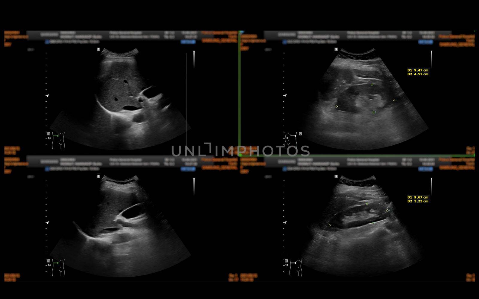 Ultrasound upper abdomen showing Liver, gall bladder and kidney for screening abdominal disease.