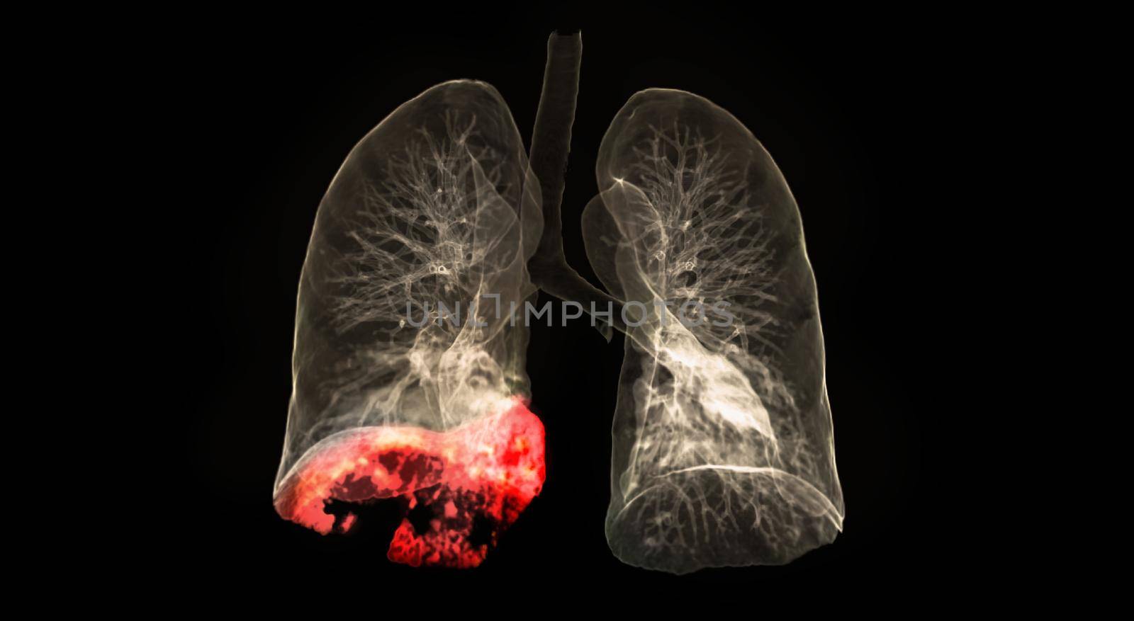 CT scan of Chest or lung 3d rendering image showing lung infection covid-19 at right lower lobe area isolated on black background. by samunella