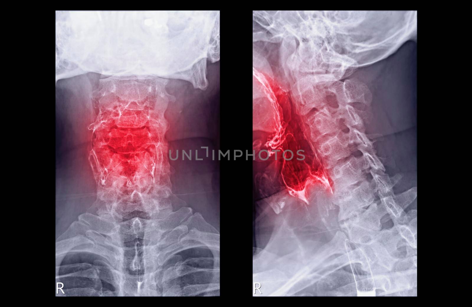 Esophagram or Barium swallow AP and Lateral view showing esophagus for diagnosis GERD or Gastroesophageal reflux disease and Esophageal cancer.