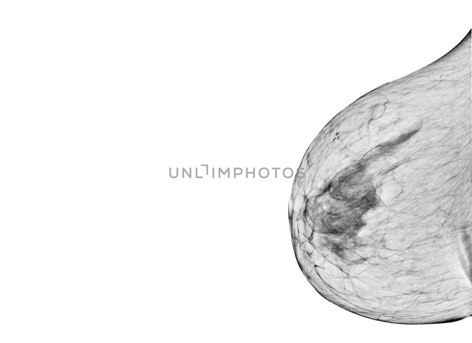 X-ray Digital Mammogram or mammography both side of the breast CC view for diagnonsis Breast cancer in women by samunella