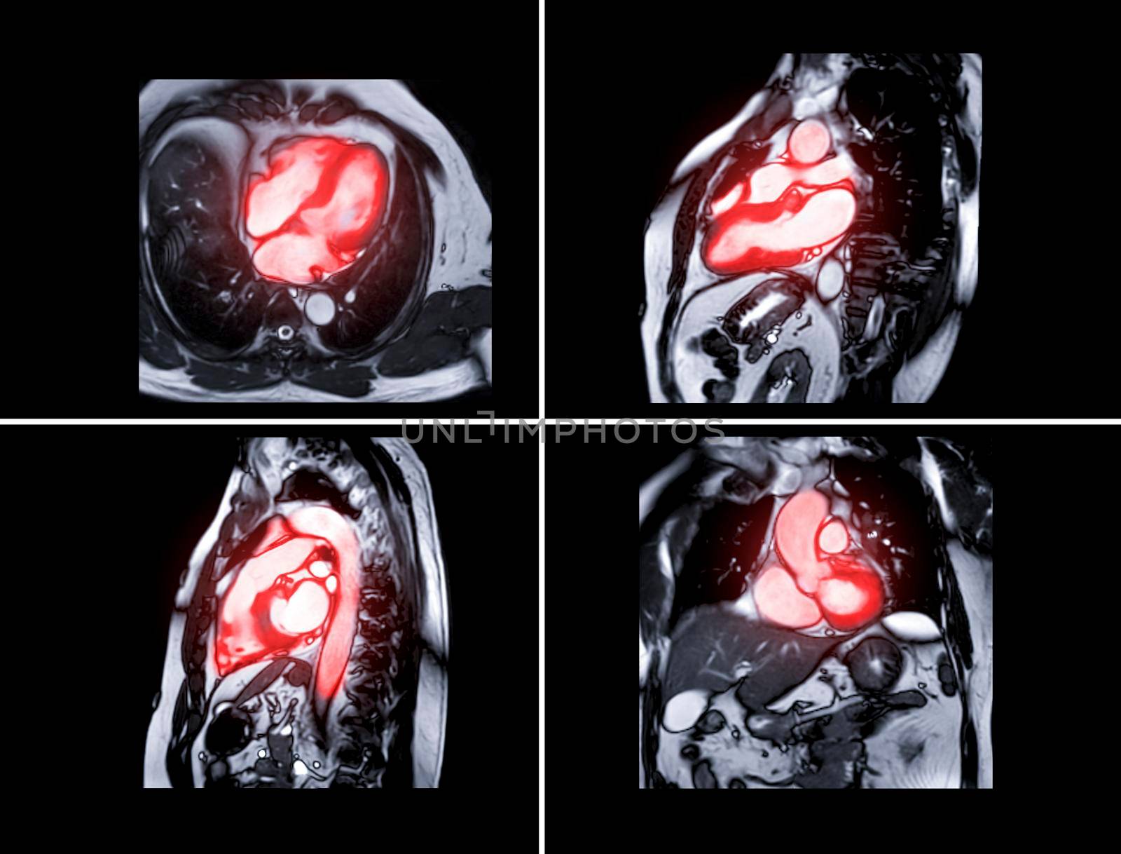 Collection of MRI heart or Cardiac MRI magnetic resonance imaging of heart for diagnosis heart disease.