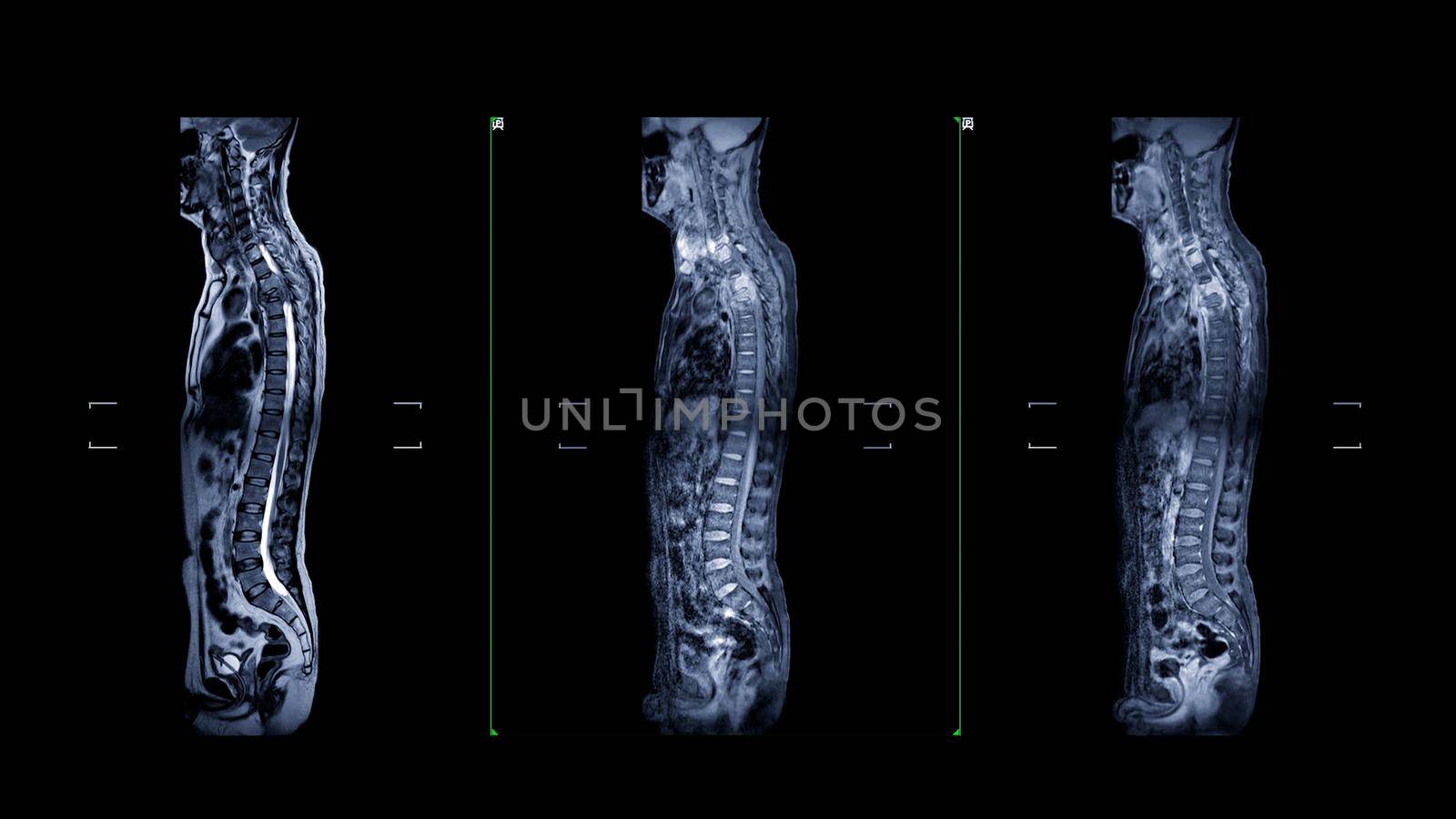 MRI of whole spine T2W , T1FS and T1FS with Gadolnilum contrast sagittal plane for diagnostic Spinal Cord Compression.