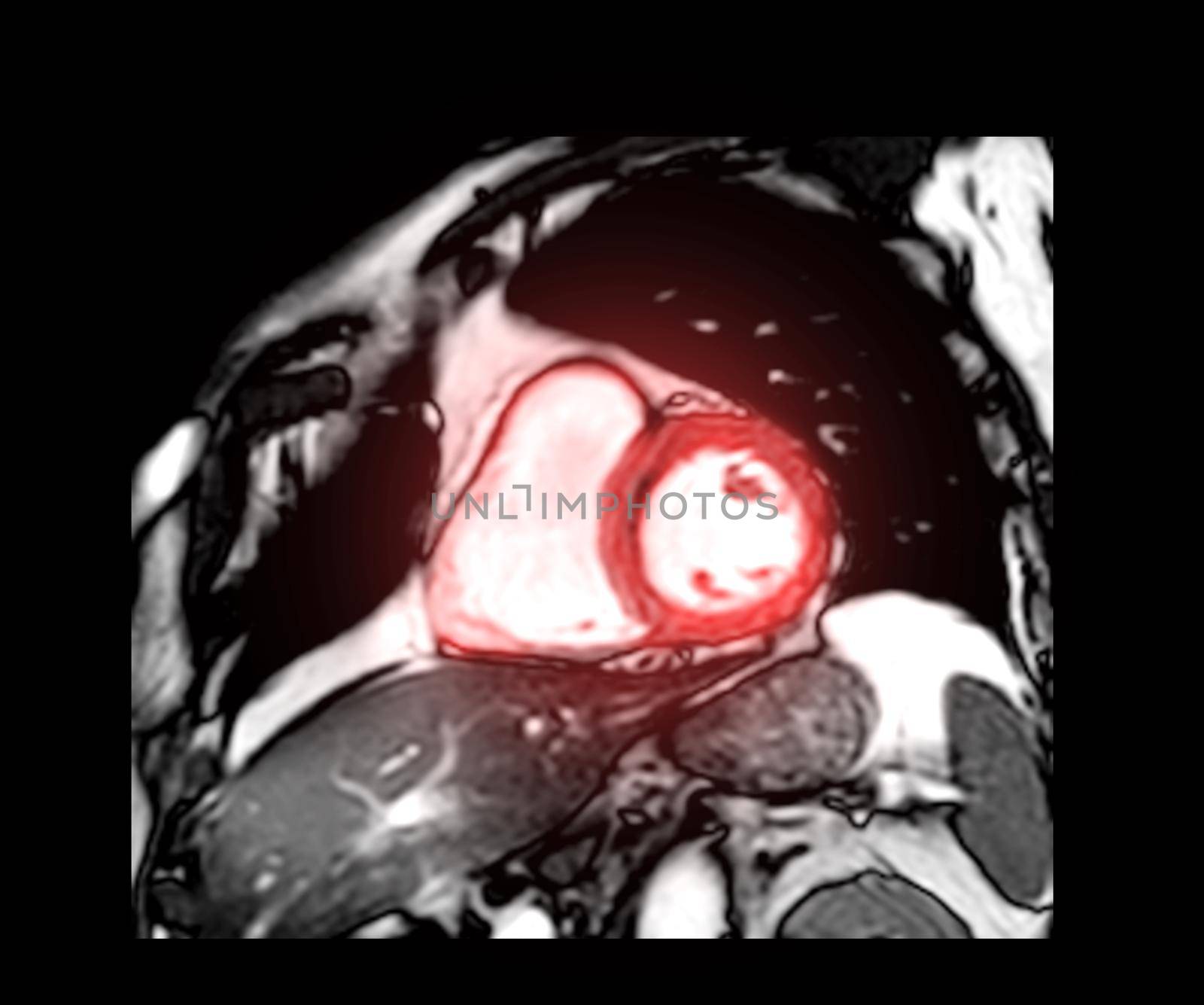 MRI heart or Cardiac MRI ( magnetic resonance imaging ) of heart short axis view for diagnosis heart disease. by samunella