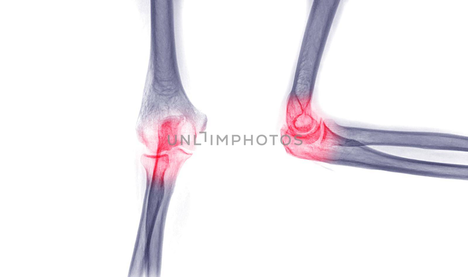 X-ray Elbow or Radiography of Right elbow AP and Lateral view for diagnostic fracture of elbow.