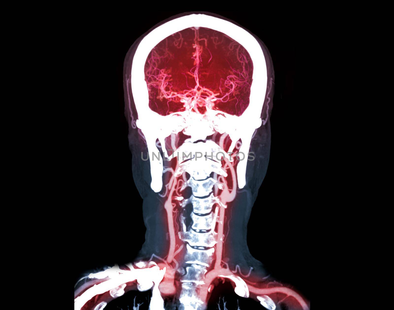 Collection of CTA brain or CT angiography of the brain comparison Mip technique Axial view for detect brain anueurym. by samunella