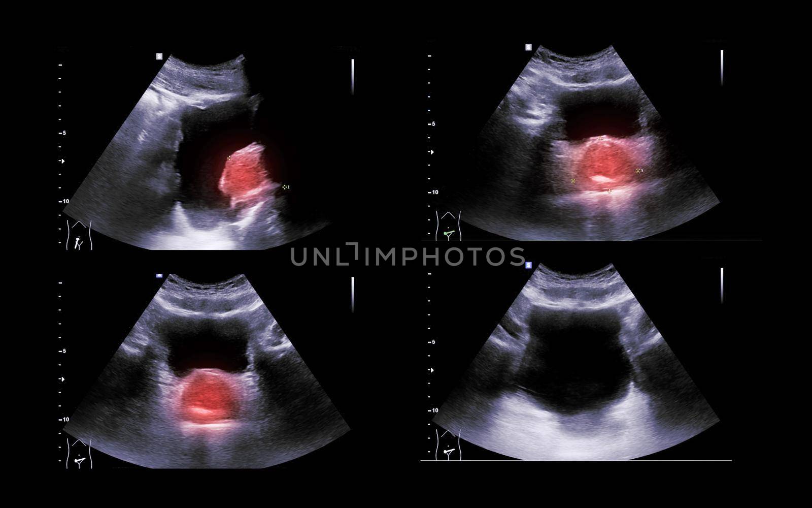 Ultrasound of urinary bladder or KUB for screening renal and bladder disease.