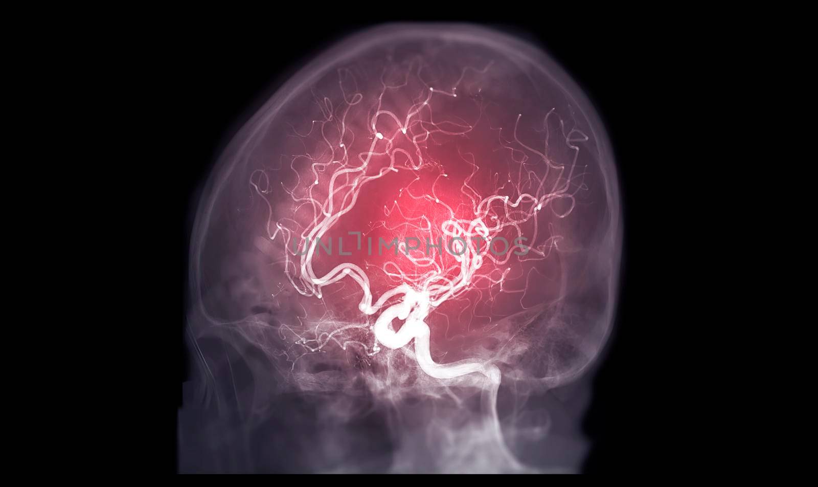 Cerebral angiography AP,Oblique and Lateral view image from Fluoroscopy in intervention radiology showing cerebral artery.