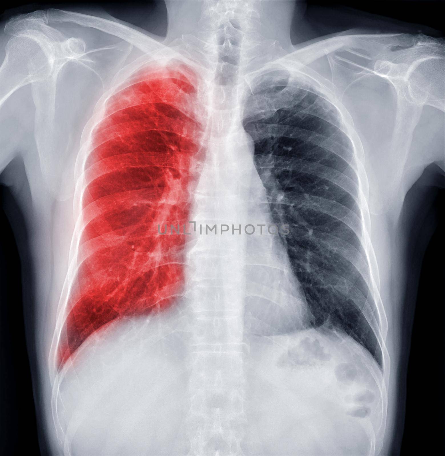 Chest X-ray Of Human Chest or Lung for detect tuberculosis