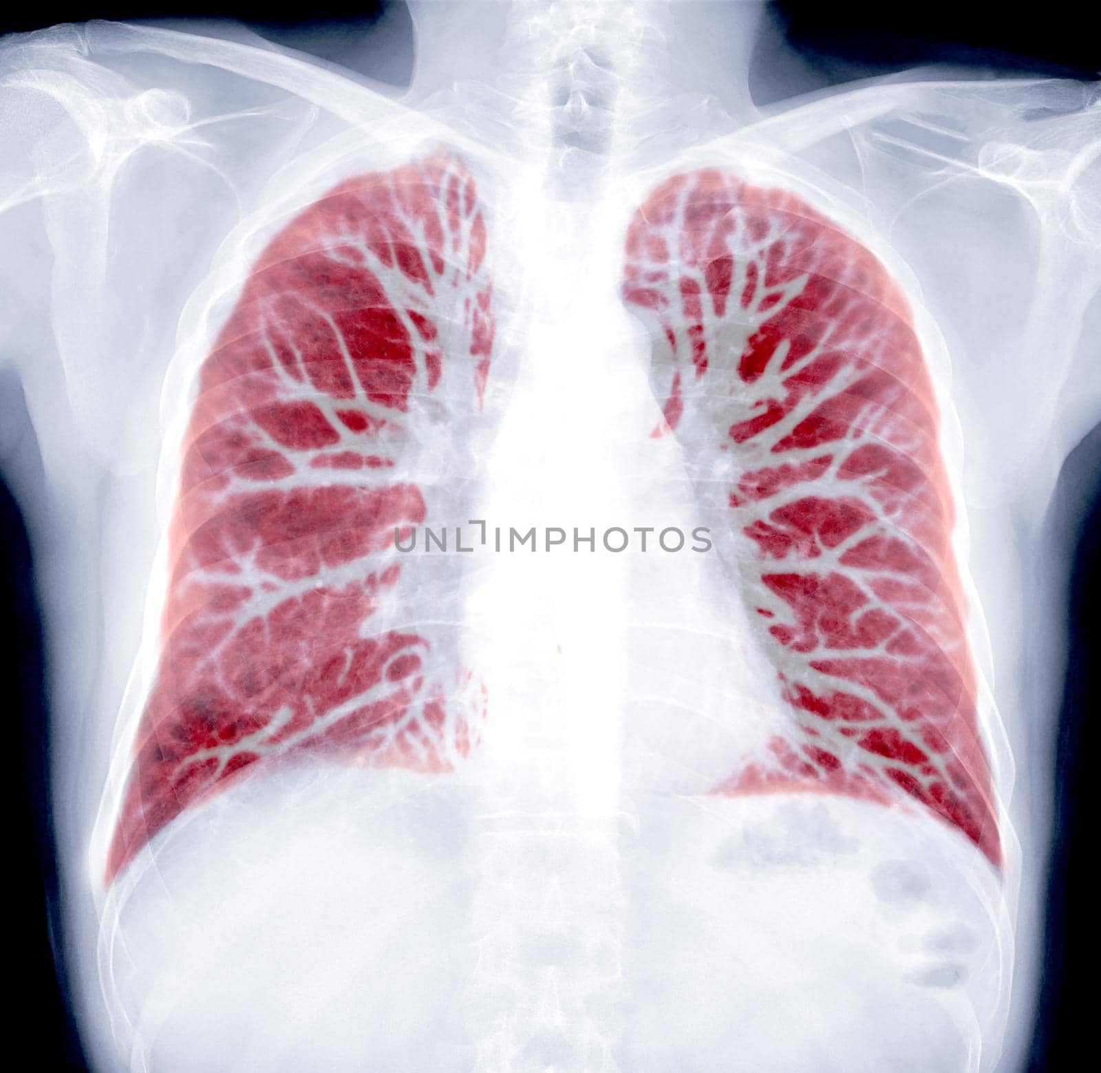 CT Chest Lung preset for detected tuberculosis
Tuberculosis (TB) and coronavirus 2019.