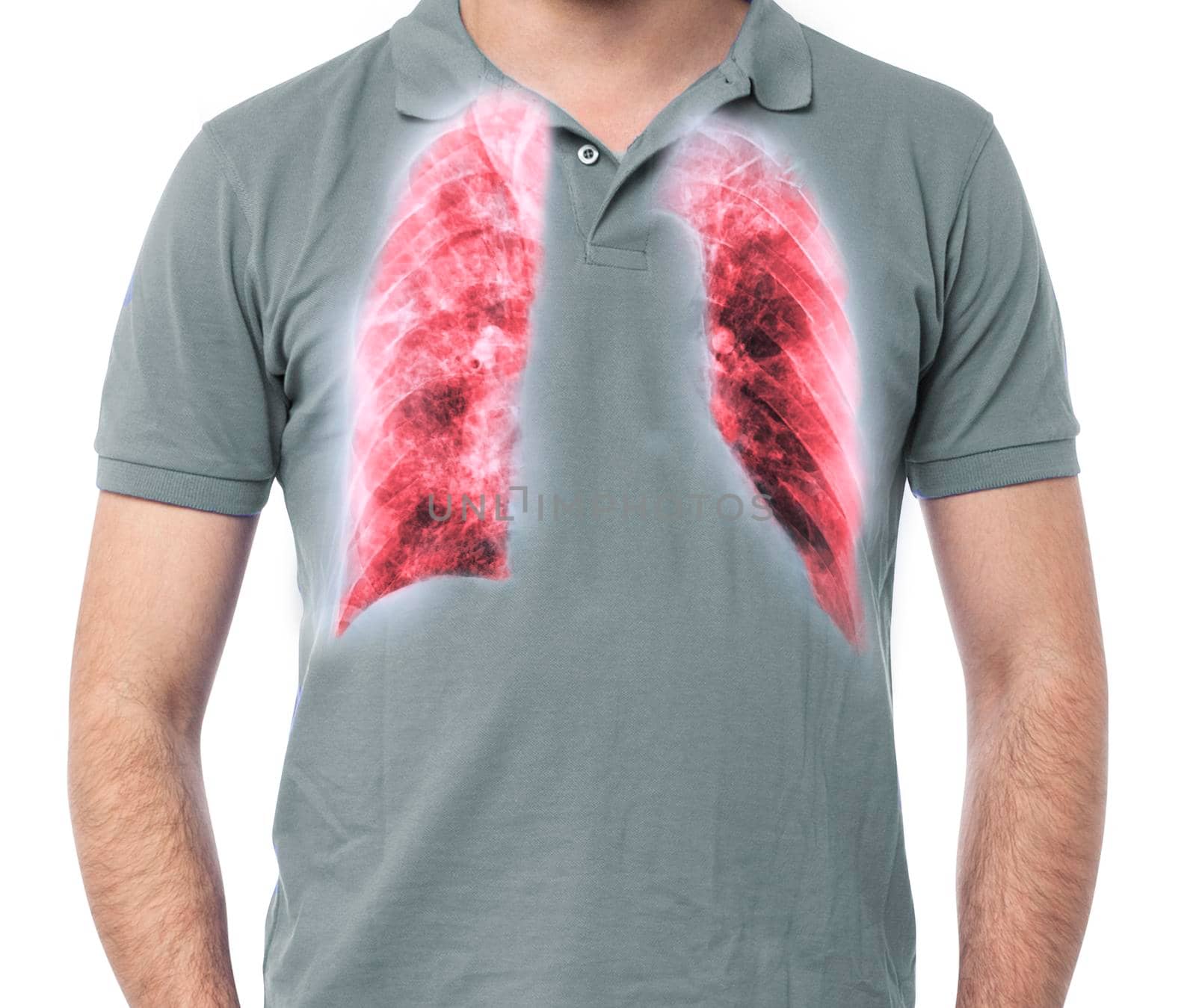 Chest X-ray or X-Ray Image Of Human Chest or Lung ( red zone ) inside thorax showing tuberculosis by samunella