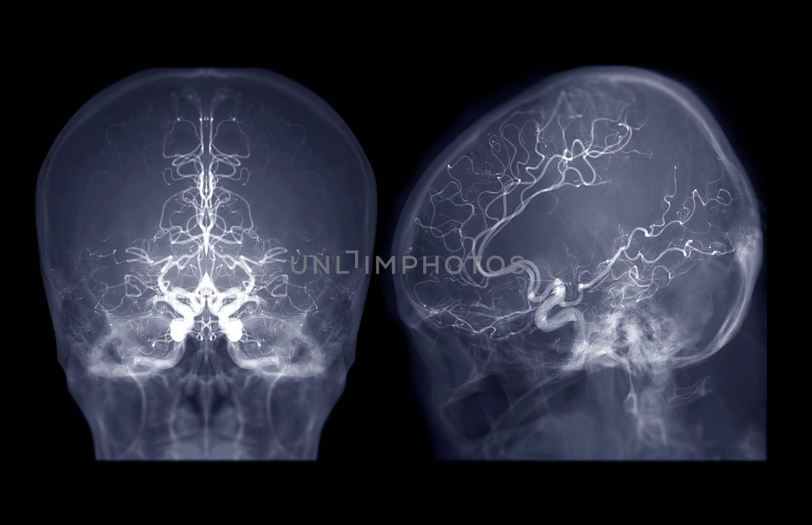 Cerebral angiography AP and Lateral view image from Fluoroscopy in intervention radiology showing cerebral artery. by samunella