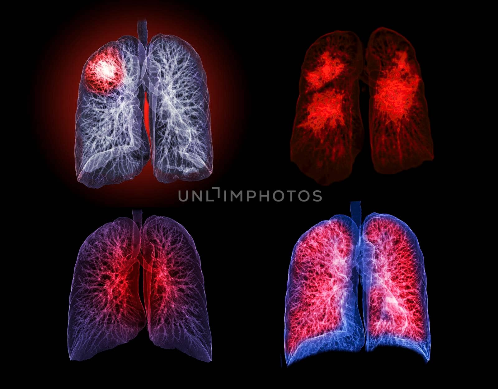 Selective focus of CT Chest or Lung 3D rendering image on the monitor for diagnosis TB,tuberculosis and covid-19 . by samunella