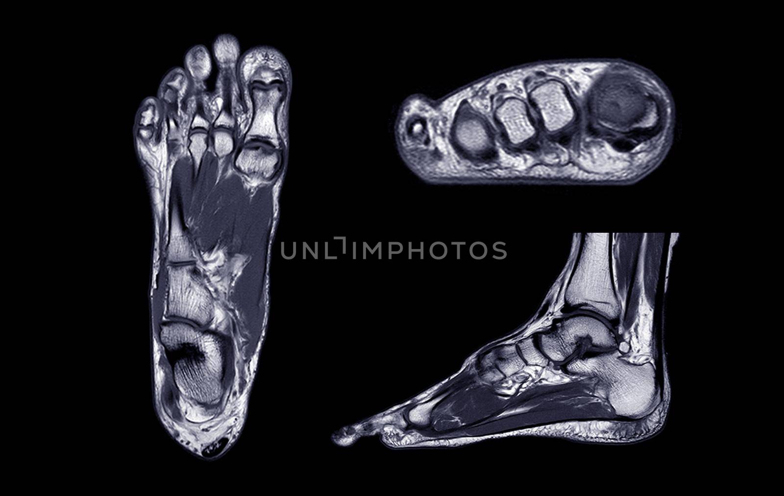 Manetic resonance imaging of foot or MRI FOOT PDW axial, Coronal and sagittal view for diagnostic tendon injury.