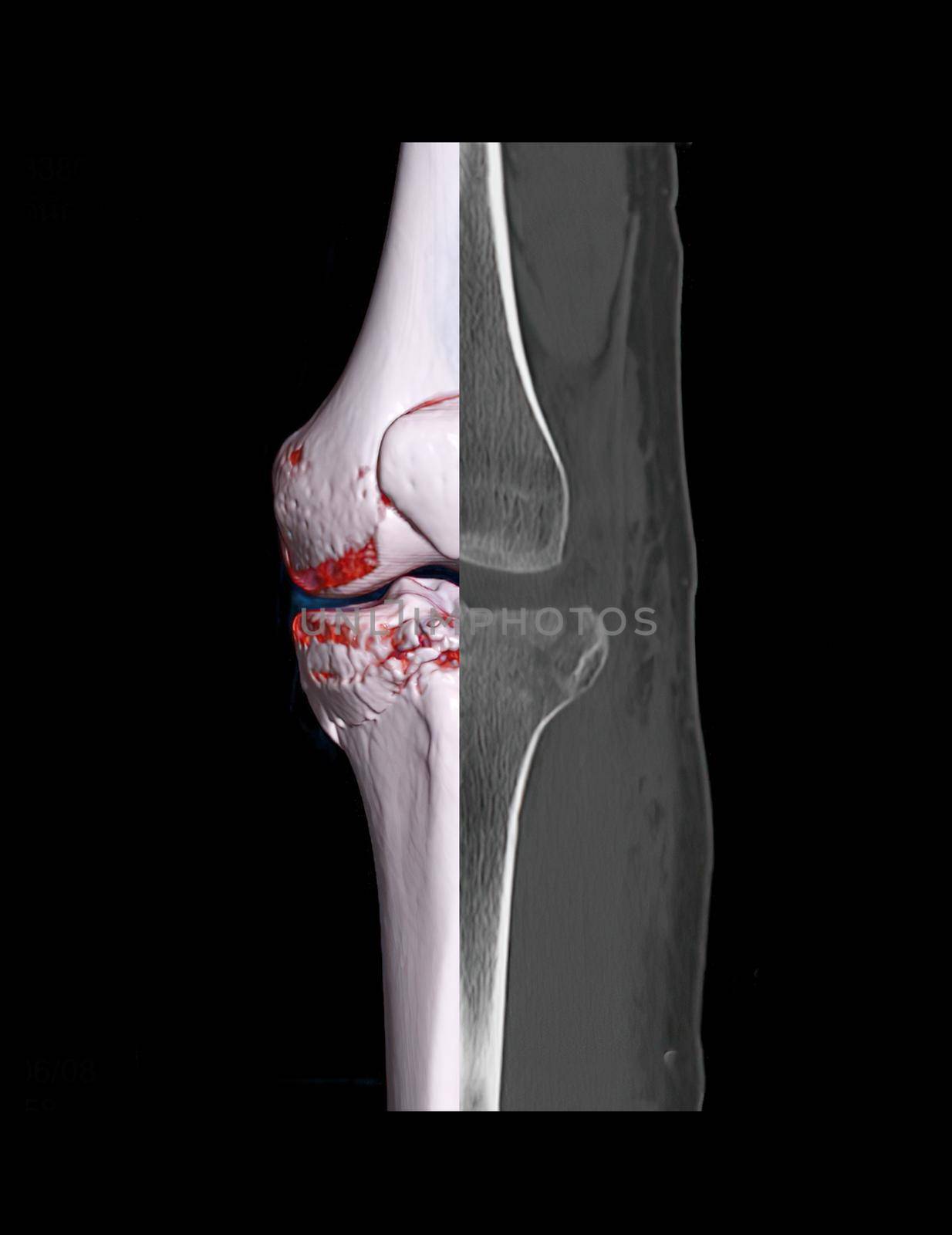 Compare of CT knee joint 3D rendering image and CT knee 2D isolated on black background showing fracture tibia bone.