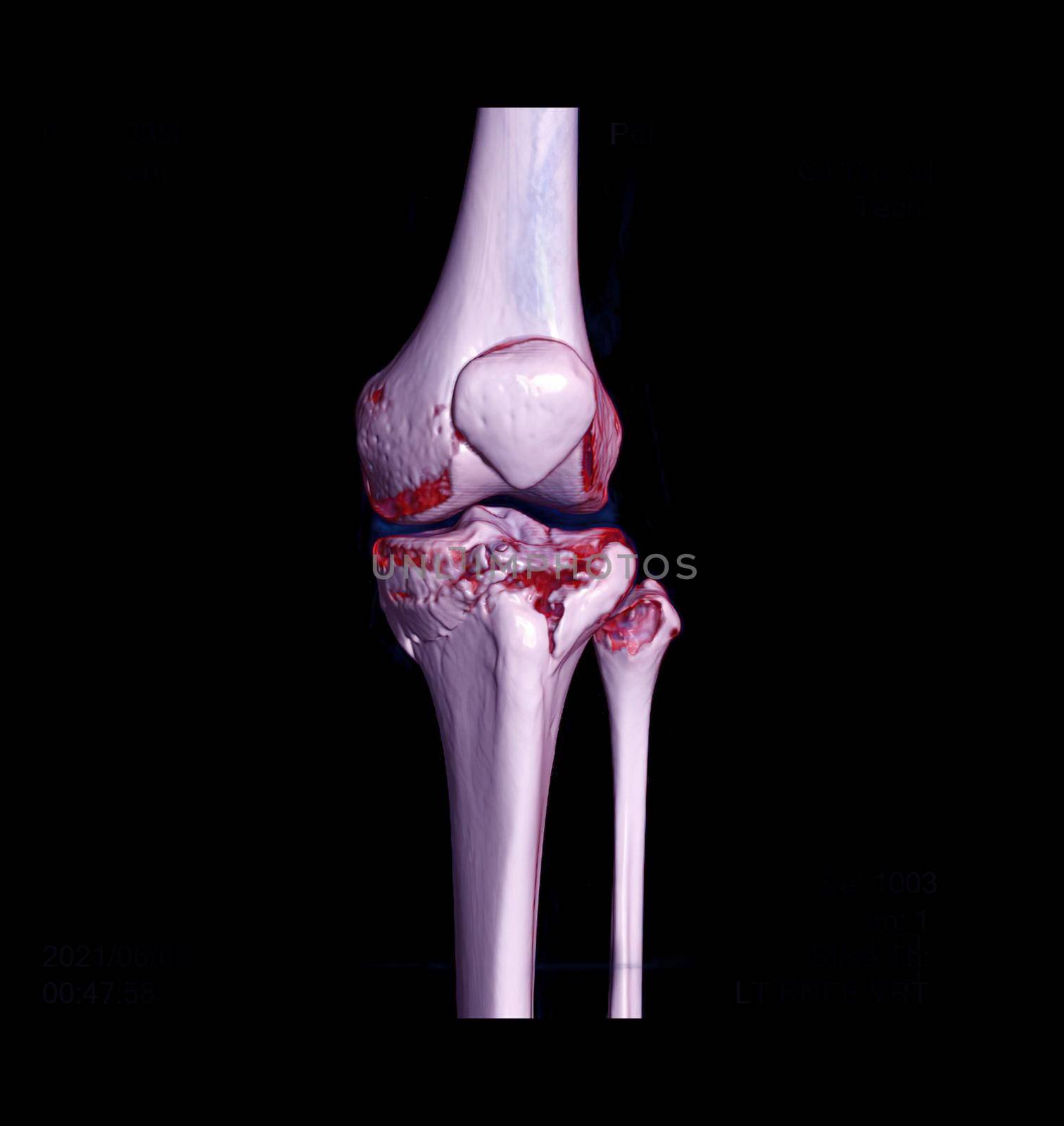 CT knee joint 3D rendering image showing fracture tibia bone