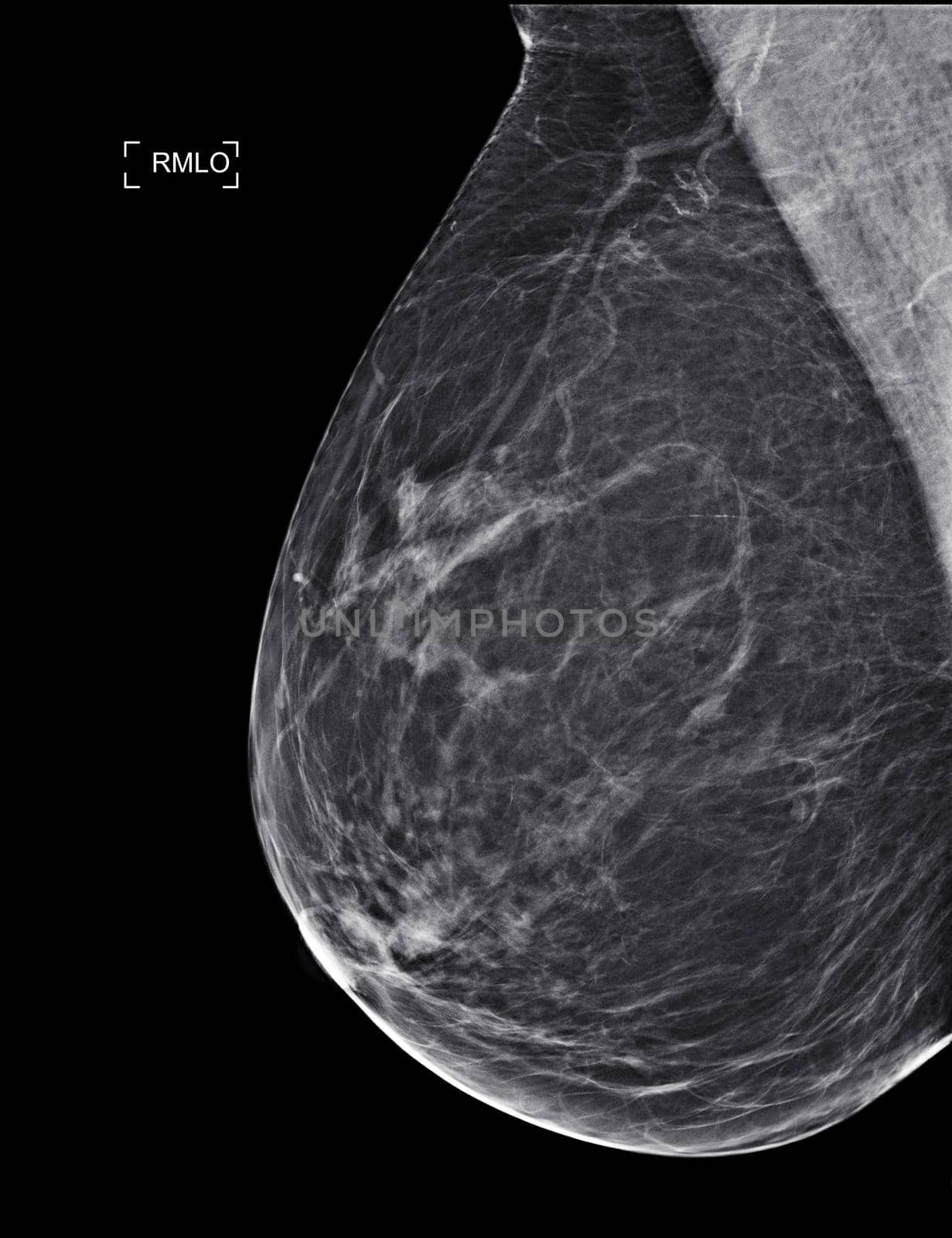 X-ray Digital Mammogram or mammography by samunella