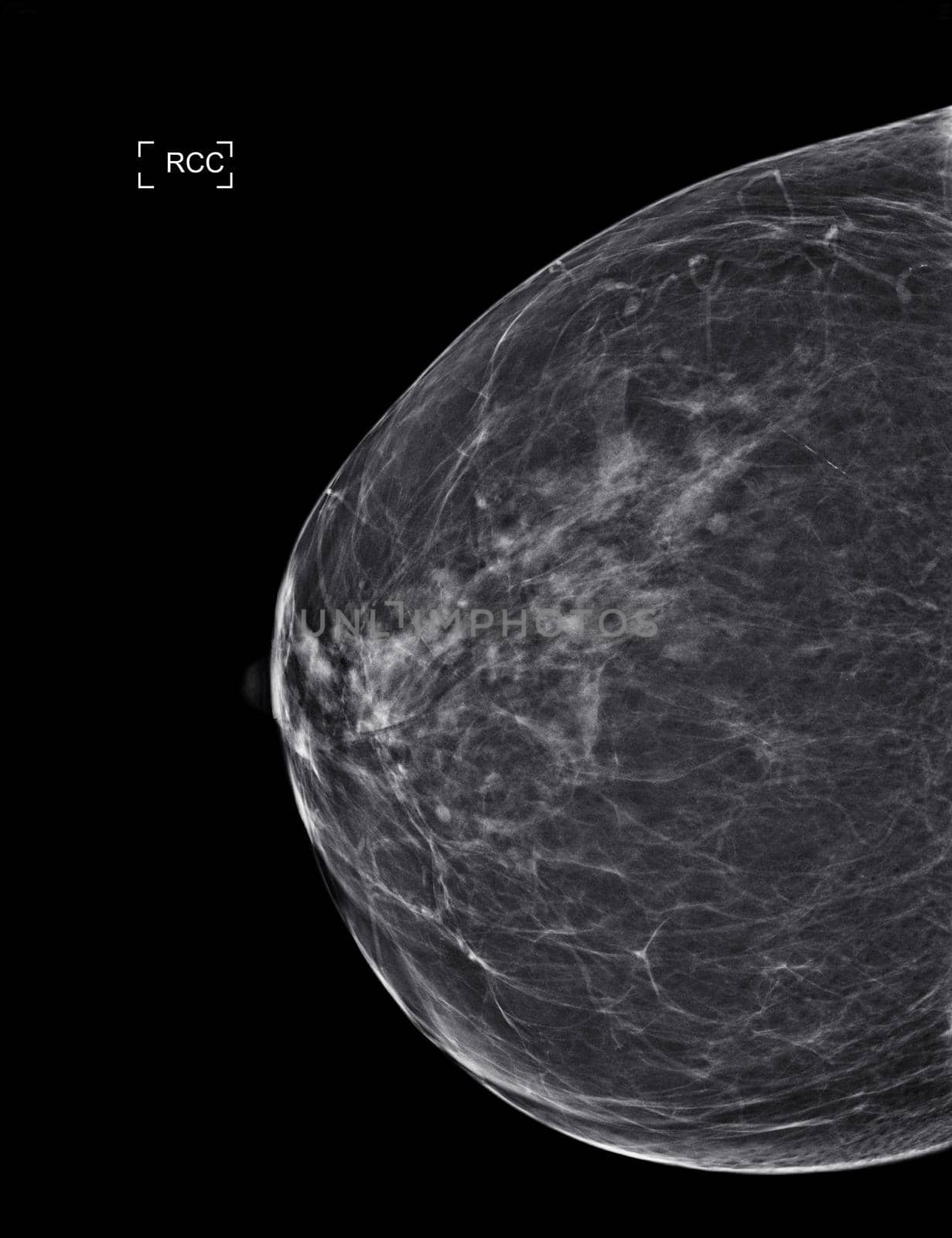 X-ray Digital Mammogram or mammography both side of the breast CC view for diagnonsis Breast cancer in women isolated on black background.