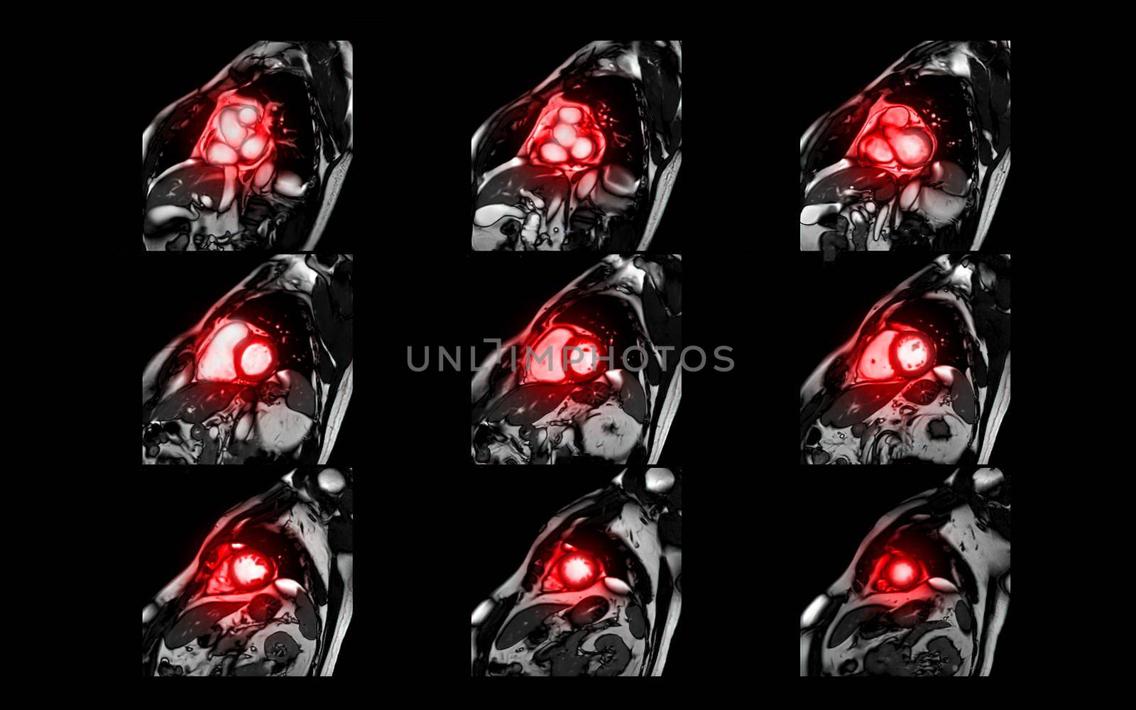 MRI heart or Cardiac MRI magnetic resonance imaging of heart in short axis view showing cross-sections of the left and right ventricle for detecting heart disease. by samunella