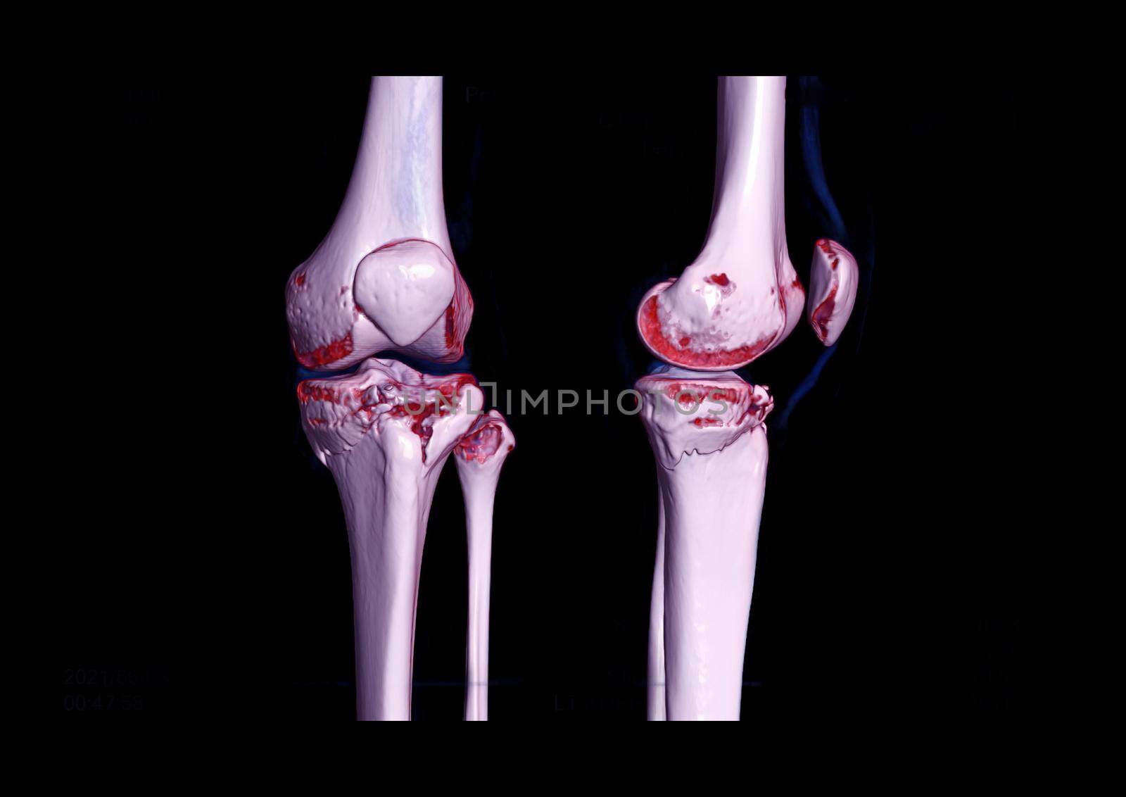 Compare AP and lateral view of CT knee joint 3D rendering image showing fracture tibia bone. by samunella